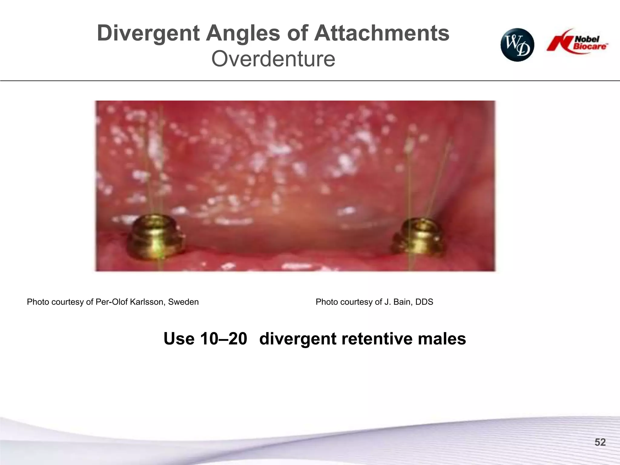 Divergent Angles of Attachments
                           Overdenture




Photo courtesy of Per-Olof Karlsson, Sweden        Photo courtesy of J. Bain, DDS



                                  Use 10–20 divergent retentive males




                                                                                    52
 