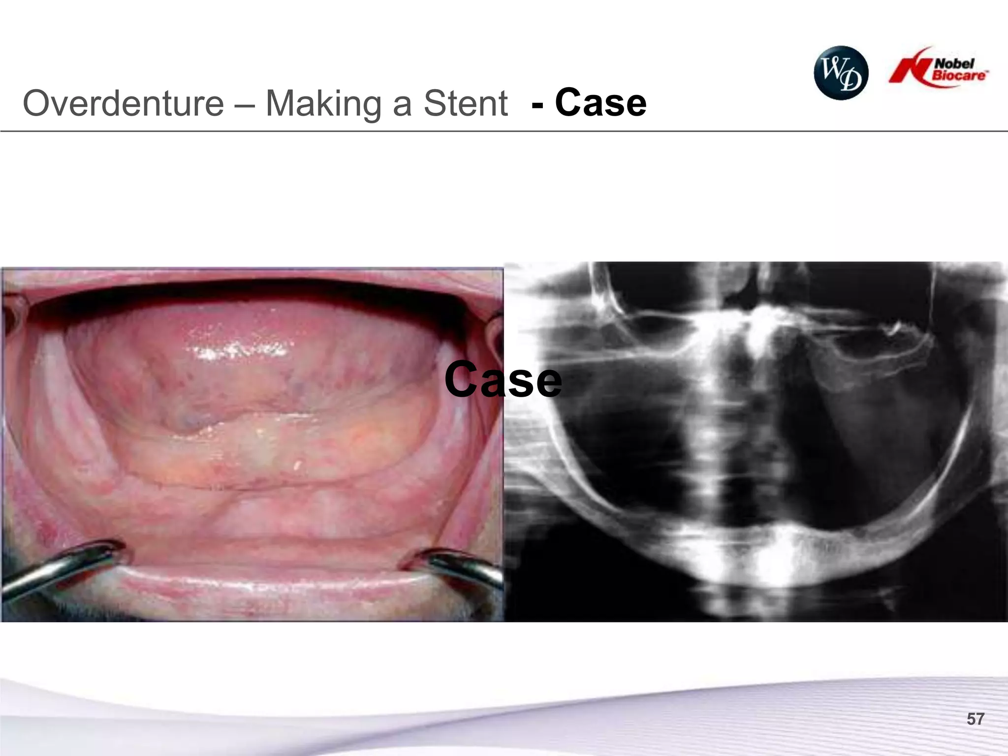 Overdenture – Making a Stent - Case




                       Case




                                      57
 