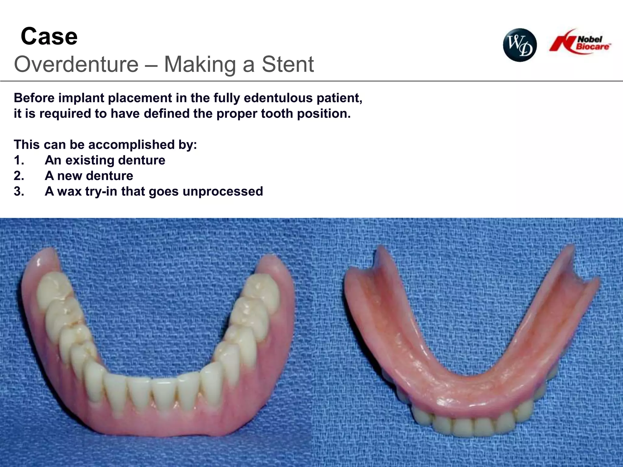 Case
Overdenture – Making a Stent
Before implant placement in the fully edentulous patient,
it is required to have defined the proper tooth position.

This can be accomplished by:
1.   An existing denture
2.   A new denture
3.   A wax try-in that goes unprocessed




                                                            58
 