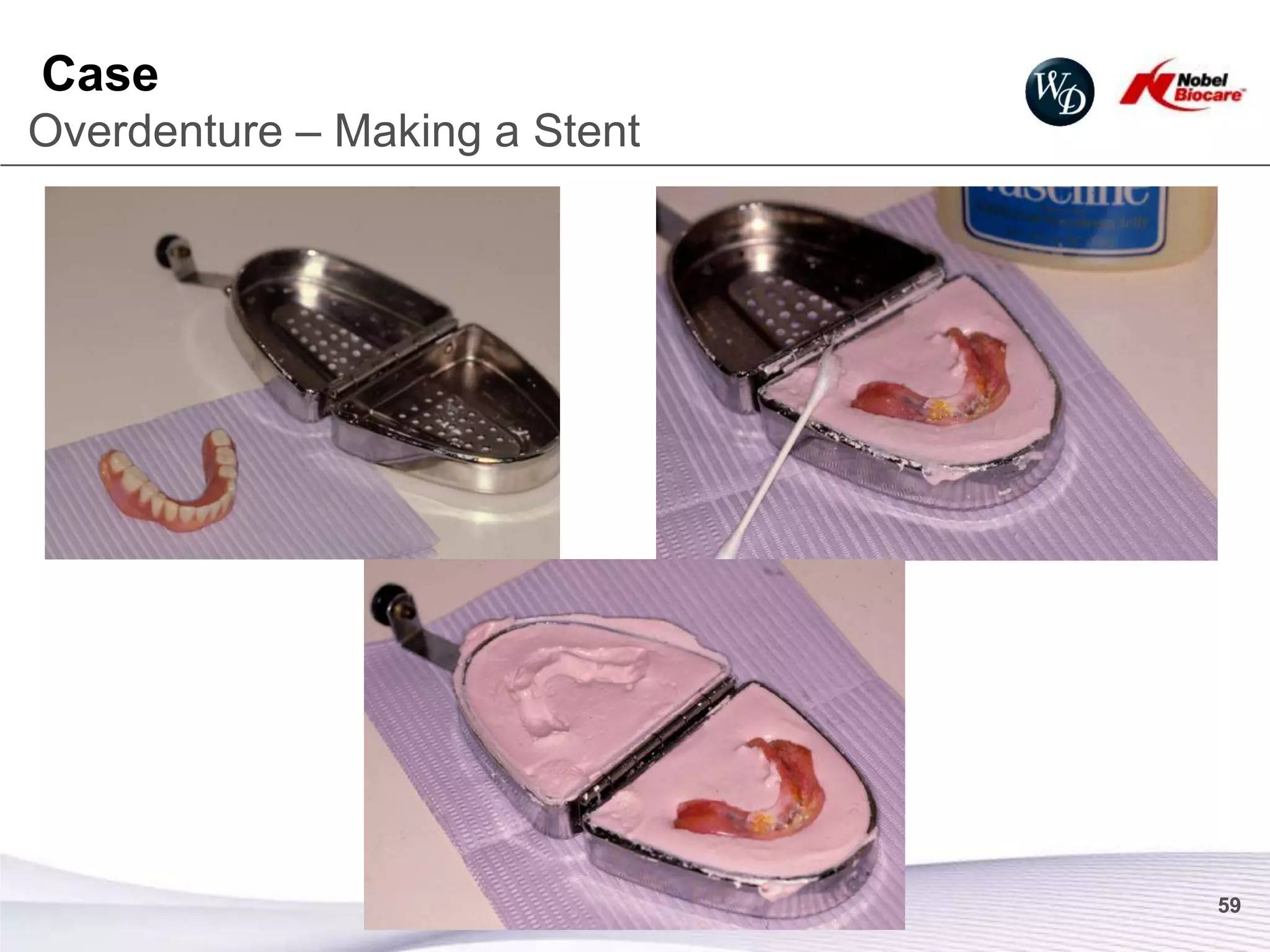 Case
Overdenture – Making a Stent




                               59
 