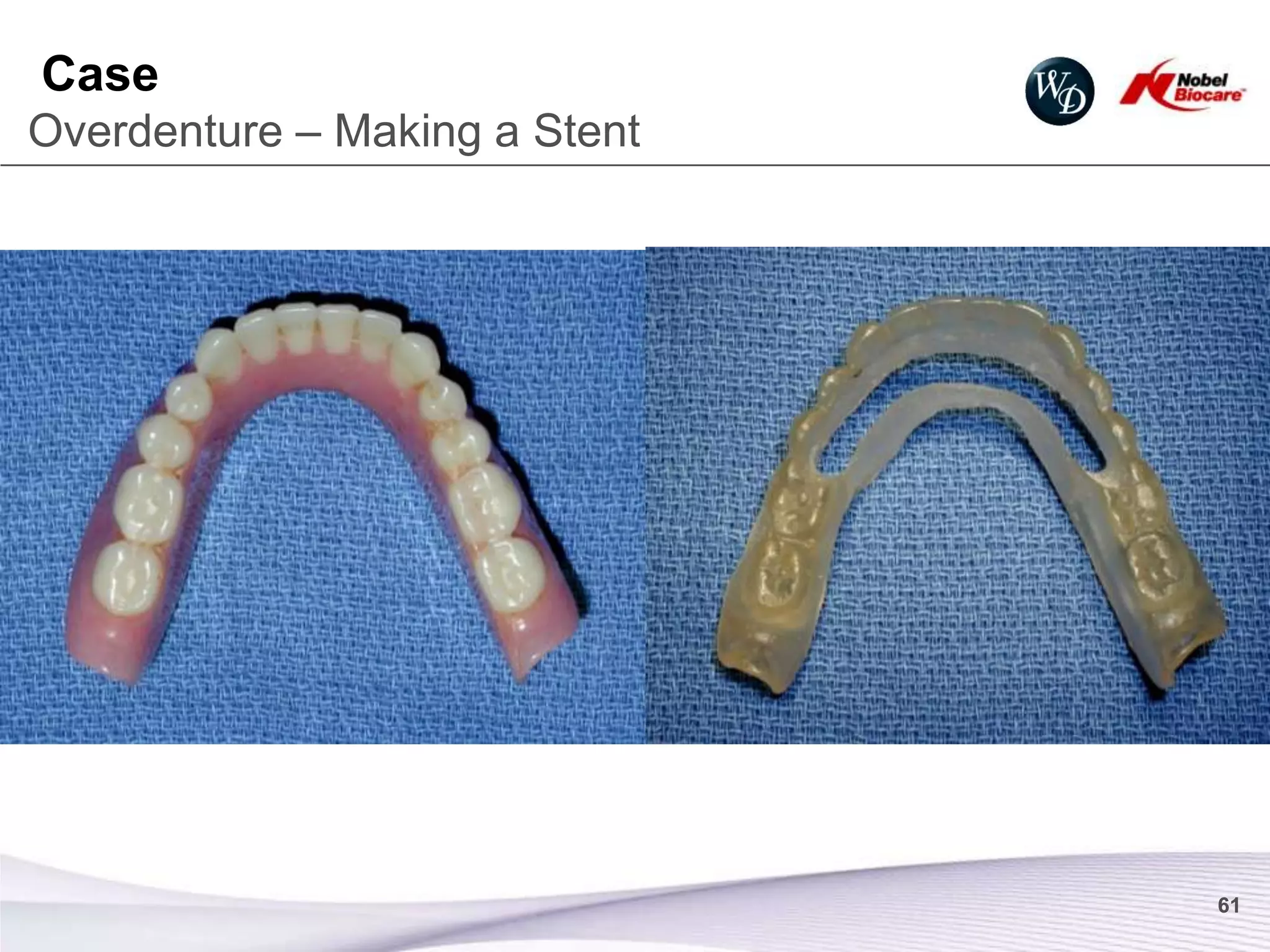 Case
Overdenture – Making a Stent




                               61
 