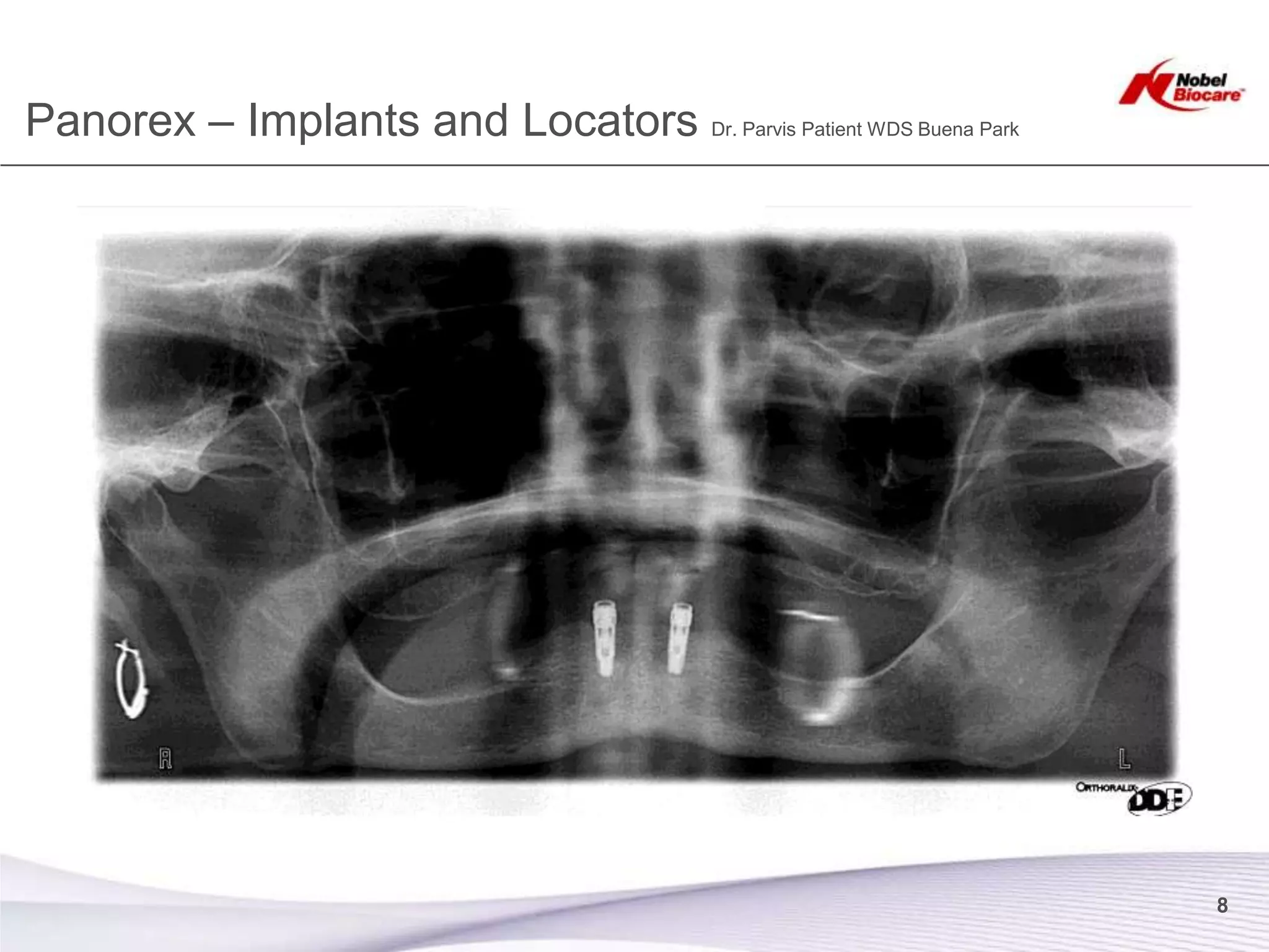 Panorex – Implants and Locators Dr. Parvis Patient WDS Buena Park




                                                                    8
 