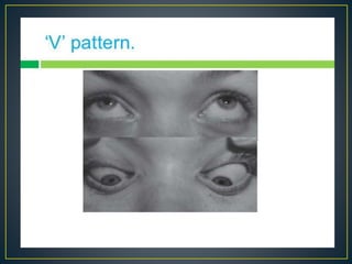Pattern Strabismus | A.V Pattern | PPTX | Eye and Vision Conditions ...
