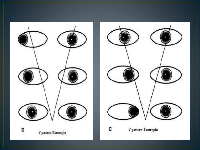 Pattern Strabismus