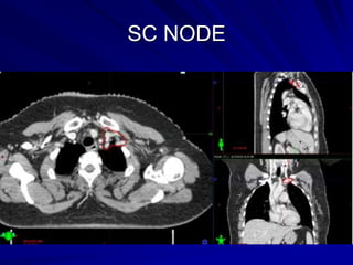 radiation therapy for students,contouring breast | PPT