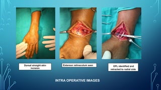 Dorsal straight skin
incision
Extensor retinaculum seen EPL identified and
retracted to radial side
INTRA OPERATIVE IMAGES
 