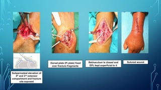 Subperiosteal elevation of
4th
and 2nd
extensor
compartment and fracture
site exposed
Dorsal plate (Pi plate) fixed
over fracture fragments
Retinaculum is closed and
EPL kept superficial to it
Sutured wound
 