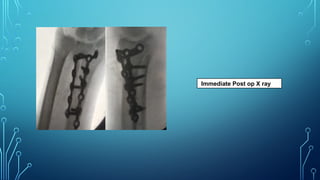 Immediate Post op X ray
 