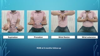 Wrist flexion Wrist extension
Supination Pronation
ROM at 6 months follow-up
 