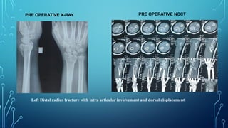 PRE OPERATIVE X-RAY PRE OPERATIVE NCCT
Left Distal radius fracture with intra articular involvement and dorsal displacement
 