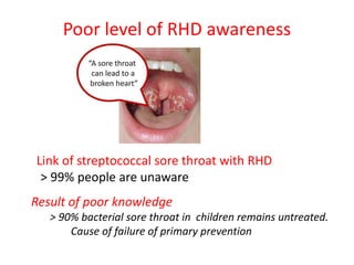 Children With Rhd Changing scenario of Rheumatic Heart Disease in Nepal | PPTX