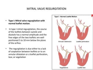 Mitral valve surgical anatomy DR NIKUNJ R SHEKHADA (MBBS ,MS GRN SURG ...