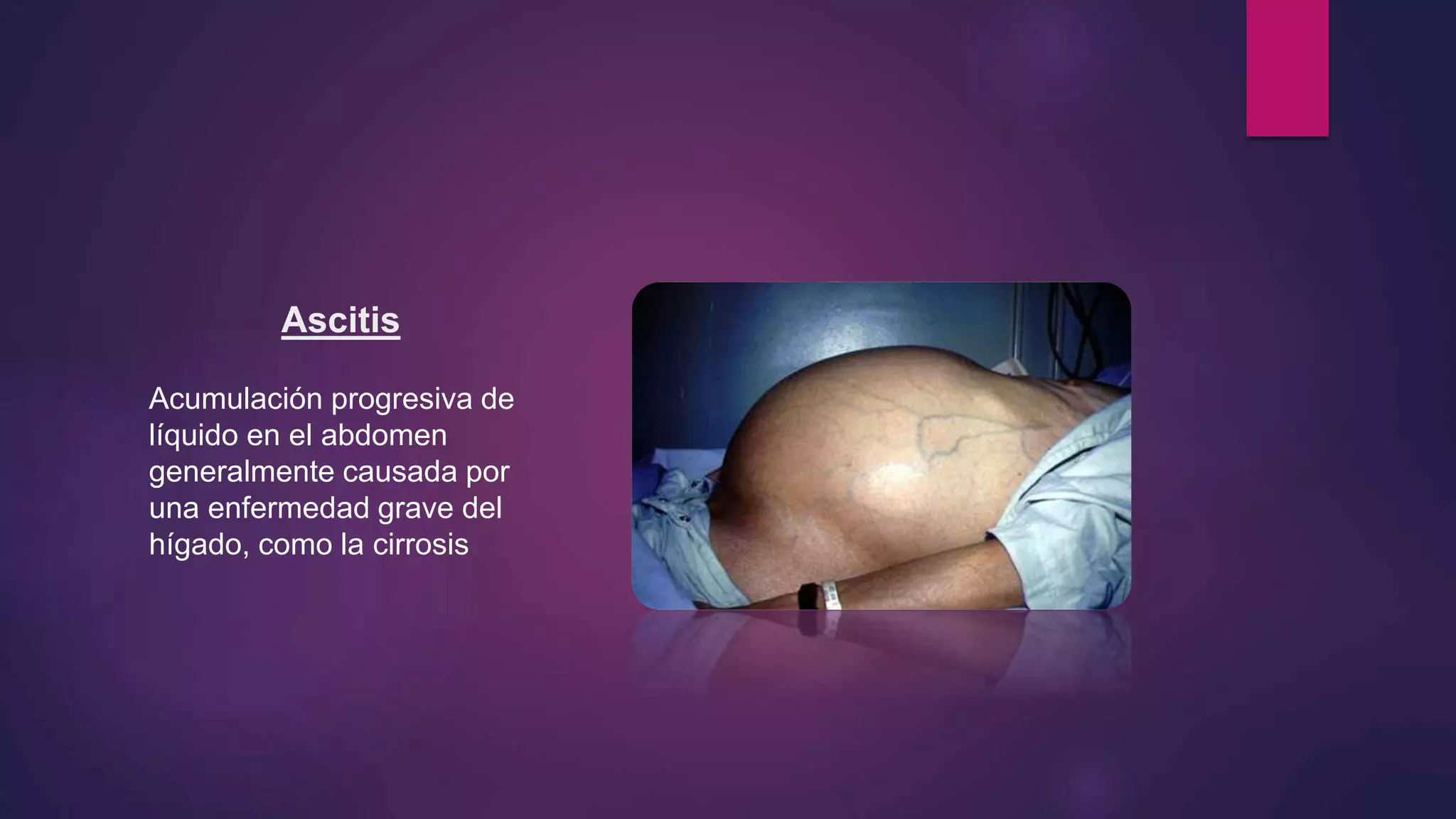 Ascitis
Acumulación progresiva de
líquido en el abdomen
generalmente causada por
una enfermedad grave del
hígado, como la cirrosis
 