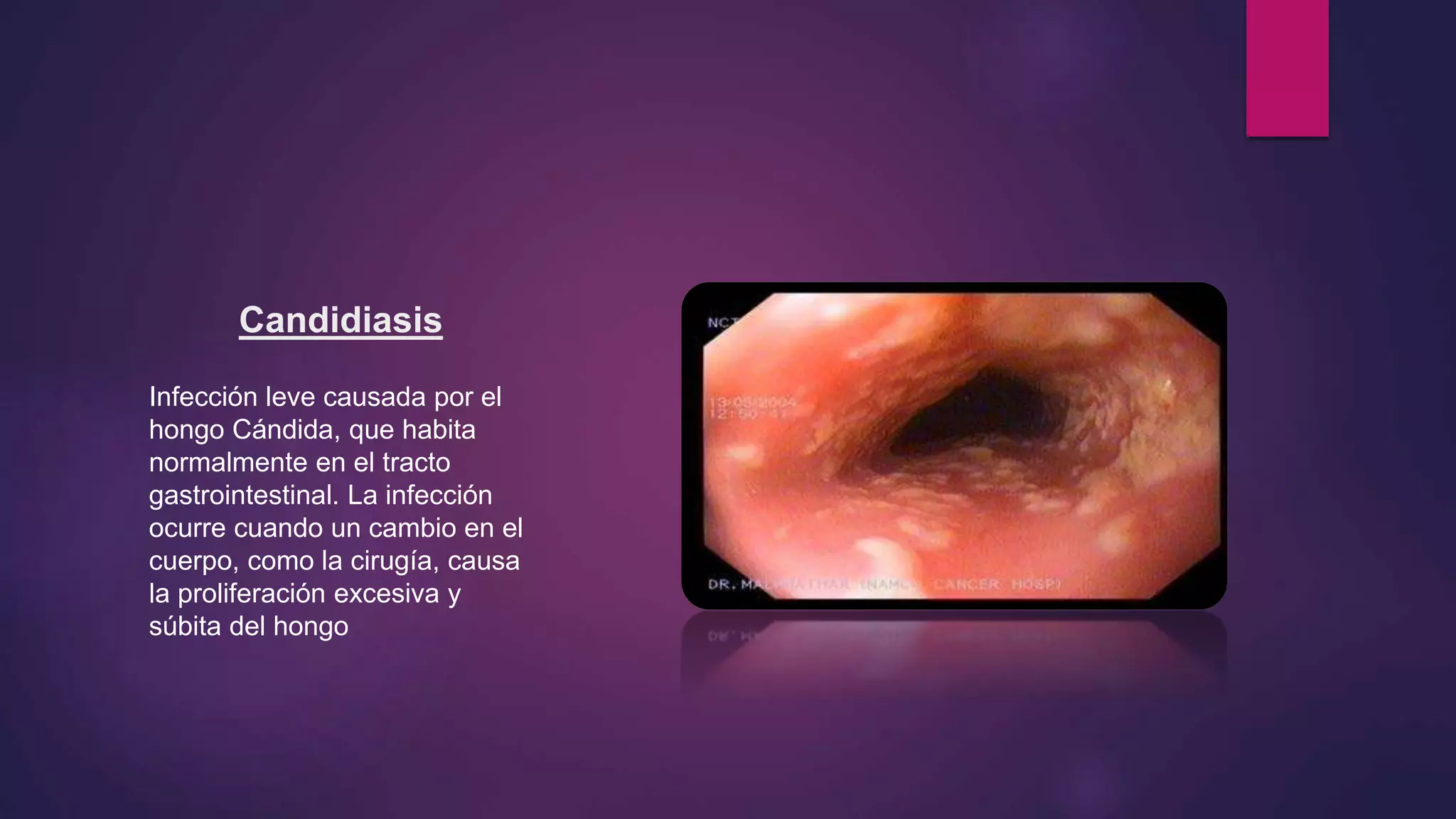 Candidiasis
Infección leve causada por el
hongo Cándida, que habita
normalmente en el tracto
gastrointestinal. La infección
ocurre cuando un cambio en el
cuerpo, como la cirugía, causa
la proliferación excesiva y
súbita del hongo
 