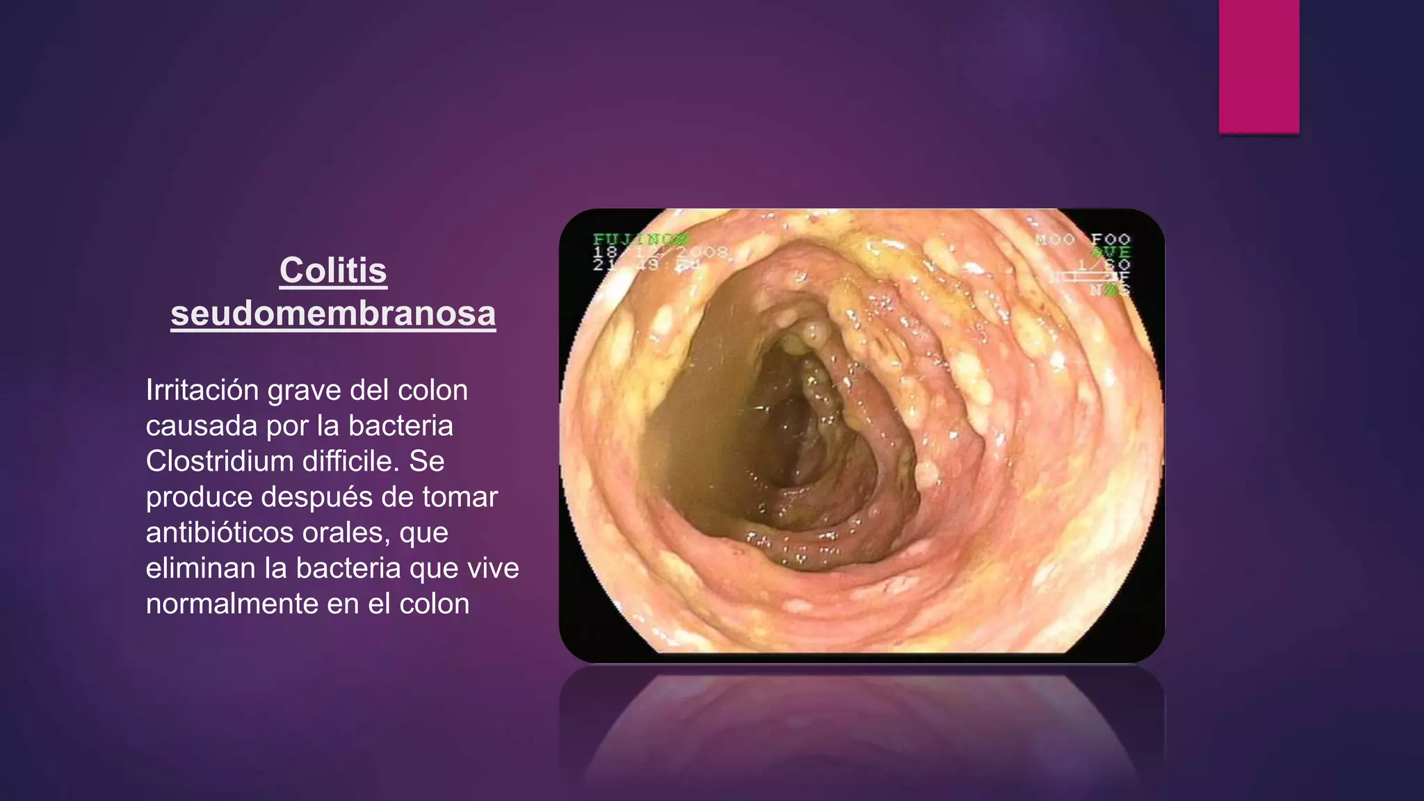 Colitis
seudomembranosa
Irritación grave del colon
causada por la bacteria
Clostridium difficile. Se
produce después de tomar
antibióticos orales, que
eliminan la bacteria que vive
normalmente en el colon
 