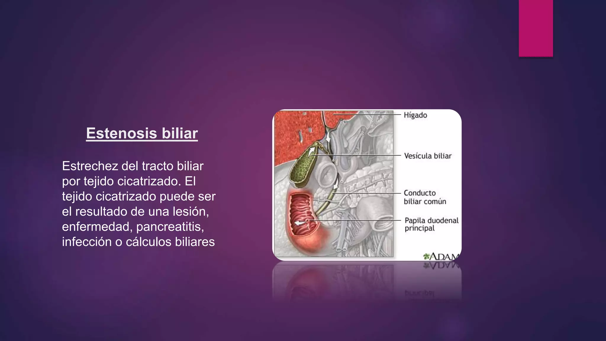 Estenosis biliar
Estrechez del tracto biliar
por tejido cicatrizado. El
tejido cicatrizado puede ser
el resultado de una lesión,
enfermedad, pancreatitis,
infección o cálculos biliares
 