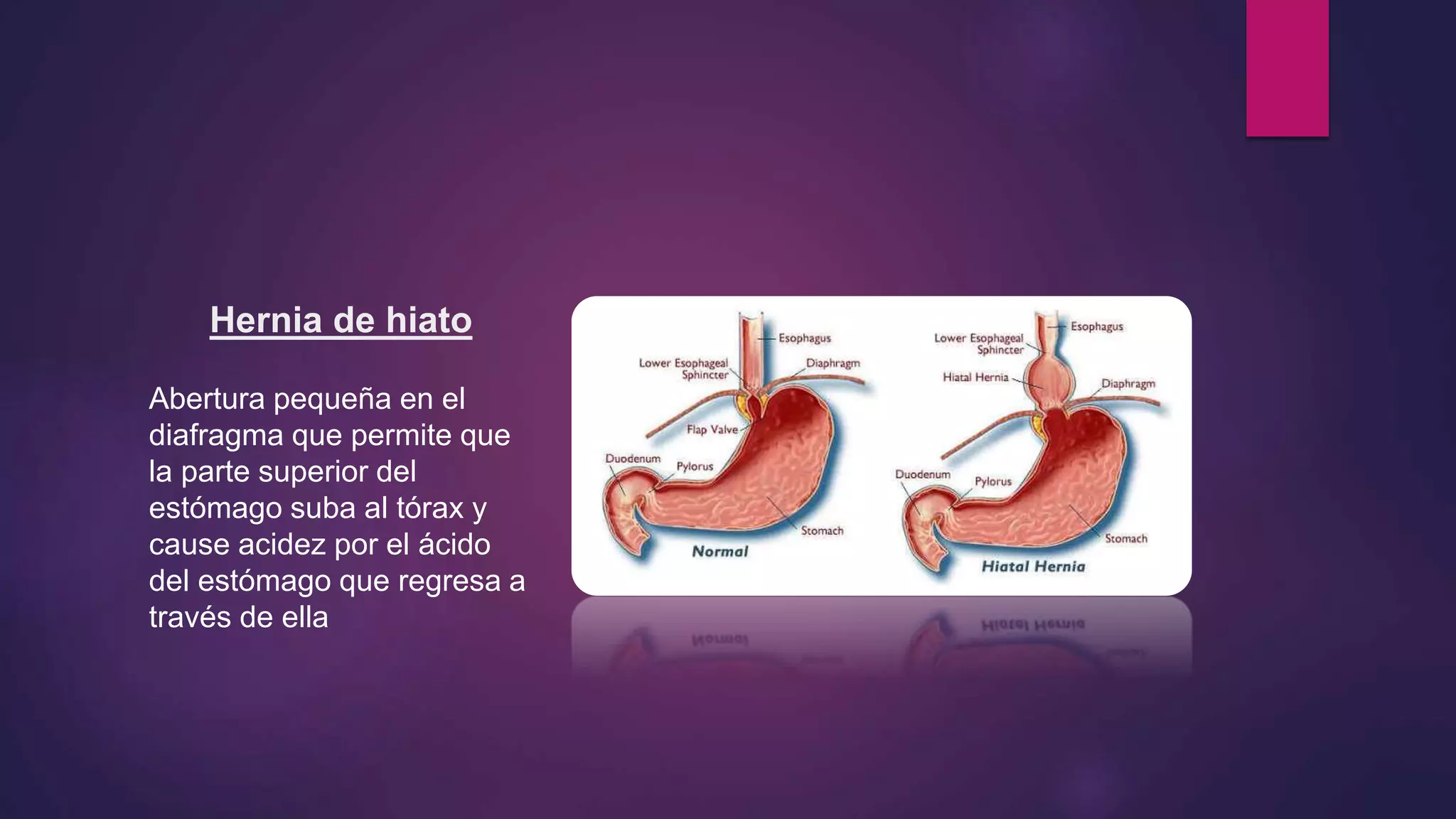 Hernia de hiato
Abertura pequeña en el
diafragma que permite que
la parte superior del
estómago suba al tórax y
cause acidez por el ácido
del estómago que regresa a
través de ella
 