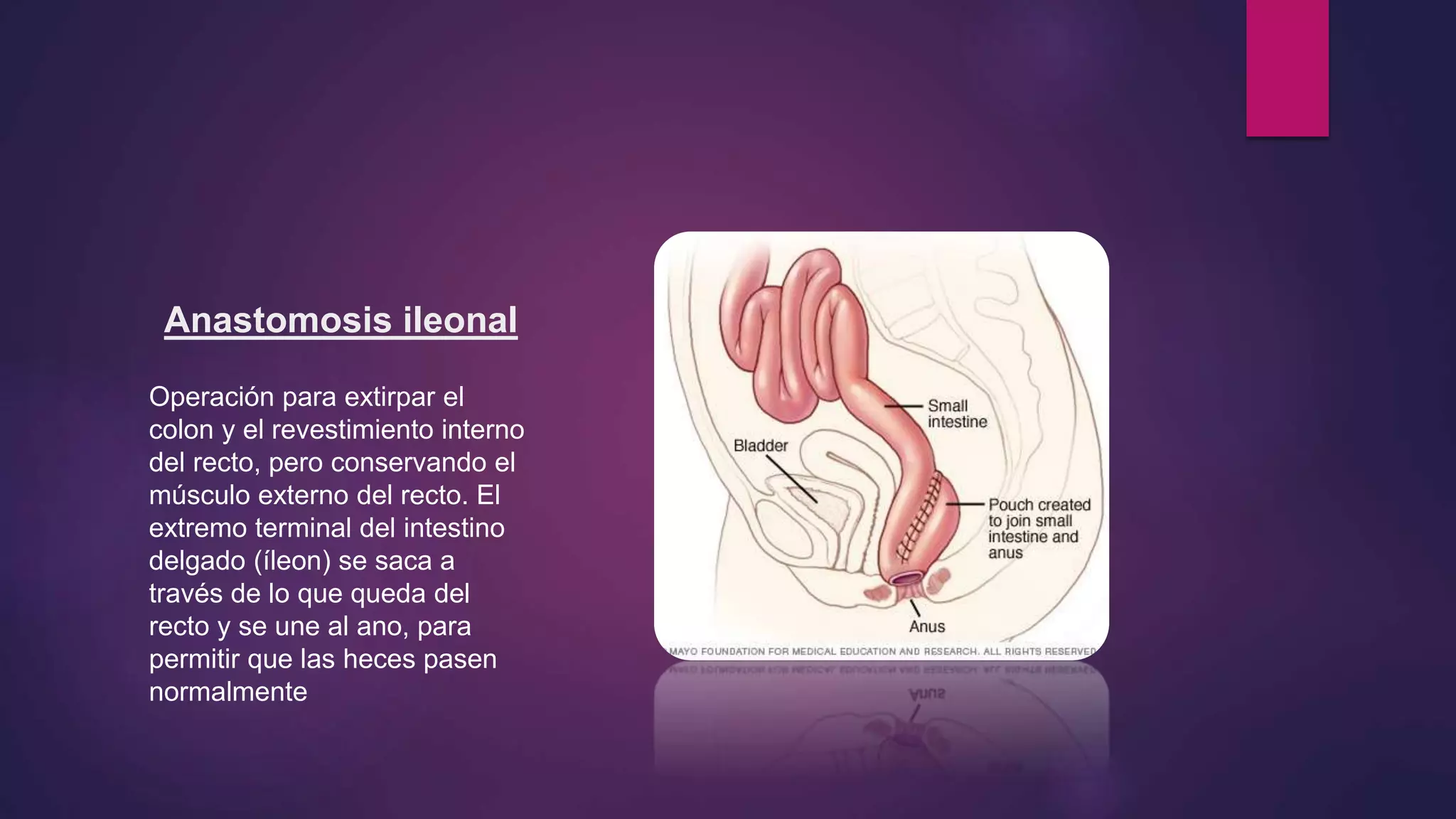 Anastomosis ileonal
Operación para extirpar el
colon y el revestimiento interno
del recto, pero conservando el
músculo externo del recto. El
extremo terminal del intestino
delgado (íleon) se saca a
través de lo que queda del
recto y se une al ano, para
permitir que las heces pasen
normalmente
 
