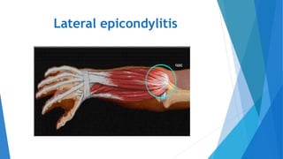Lateral epicondylitis
 