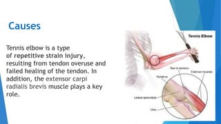 Causes
Tennis elbow is a type
of repetitive strain injury,
resulting from tendon overuse and
failed healing of the tendon. In
addition, the extensor carpi
radialis brevis muscle plays a key
role.
 