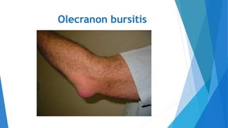 Olecranon bursitis
 