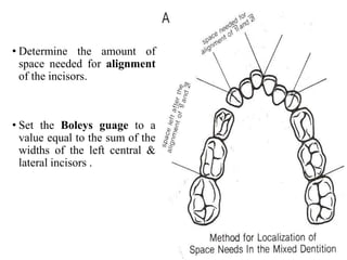 • Determine the amount of
space needed for alignment
of the incisors.
• Set the Boleys guage to a
value equal to the sum of the
widths of the left central &
lateral incisors .
 