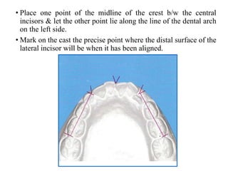 • Place one point of the midline of the crest b/w the central
incisors & let the other point lie along the line of the dental arch
on the left side.
• Mark on the cast the precise point where the distal surface of the
lateral incisor will be when it has been aligned.
 