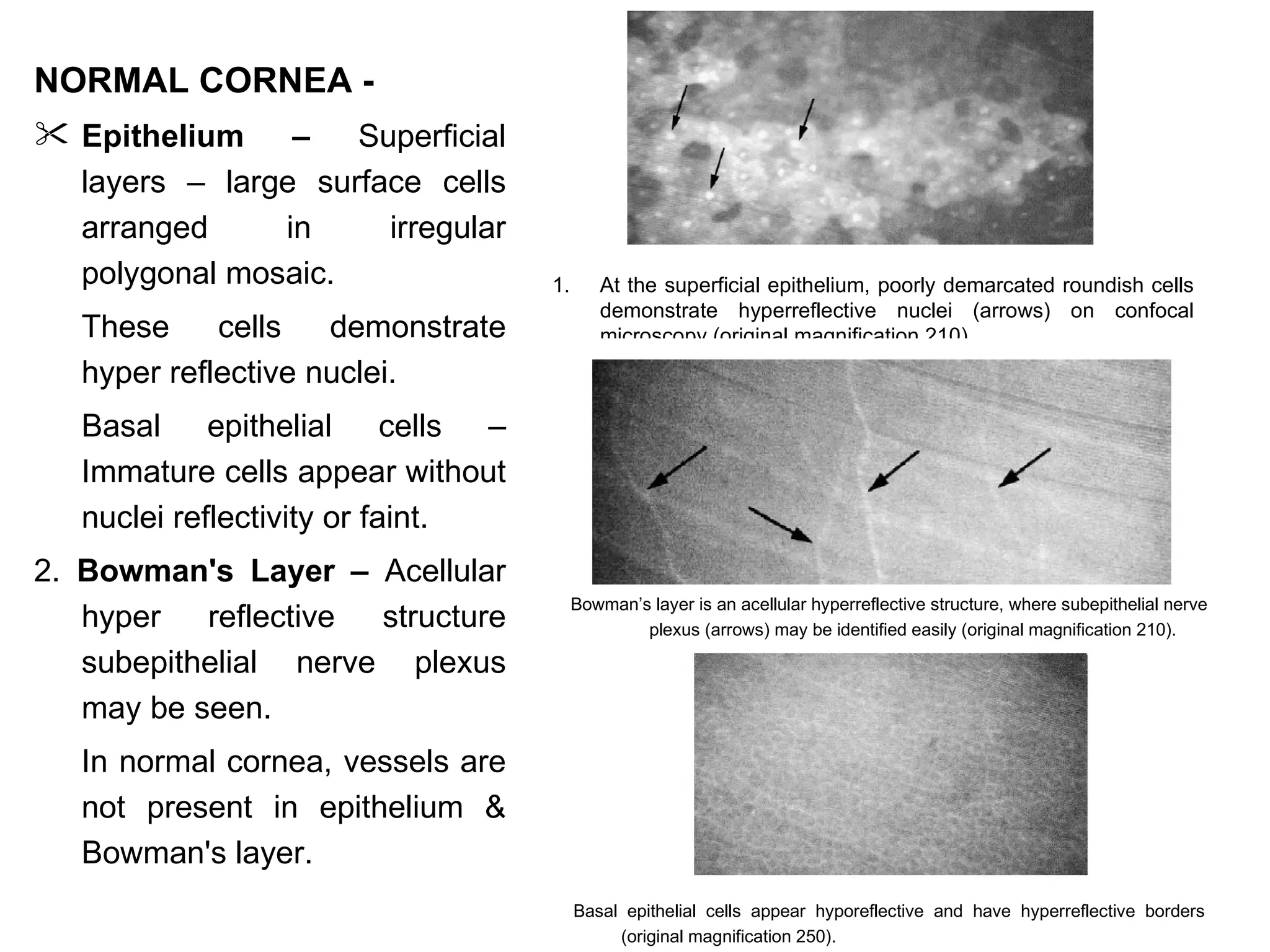 NORMAL CORNEA -
 Epithelium    –   Superficial
  layers – large surface cells
  arranged     in     irregular
  polygonal mosaic.                1.      At the superficial epithelium, poorly demarcated roundish cells
                                           demonstrate hyperreflective nuclei (arrows) on confocal
   These     cells   demonstrate           microscopy (original magnification 210).
   hyper reflective nuclei.
   Basal epithelial cells –
   Immature cells appear without
   nuclei reflectivity or faint.
2. Bowman's Layer – Acellular
                                        Bowman’s layer is an acellular hyperreflective structure, where subepithelial nerve
   hyper reflective   structure                 plexus (arrows) may be identified easily (original magnification 210).

   subepithelial nerve plexus
   may be seen.
   In normal cornea, vessels are
   not present in epithelium &
   Bowman's layer.
                                        Basal epithelial cells appear hyporeflective and have hyperreflective borders
                                             (original magnification 250).
 