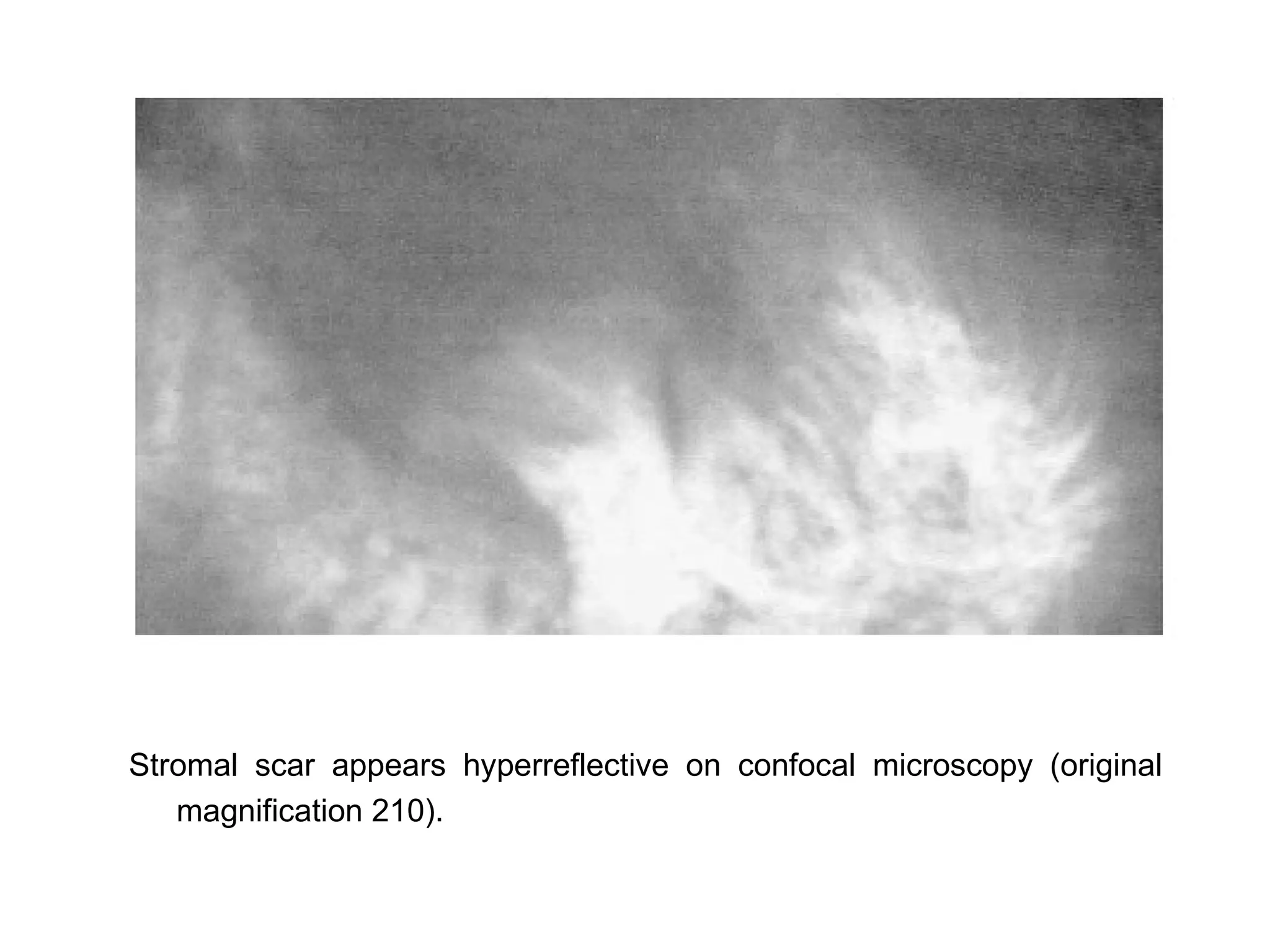 Stromal scar appears hyperreflective on confocal microscopy (original
   magnification 210).
 