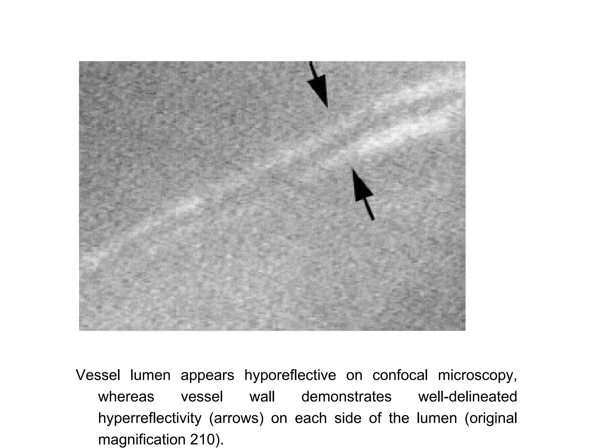 Vessel lumen appears hyporeflective on confocal microscopy,
   whereas      vessel     wall   demonstrates    well-delineated
   hyperreflectivity (arrows) on each side of the lumen (original
   magnification 210).
 