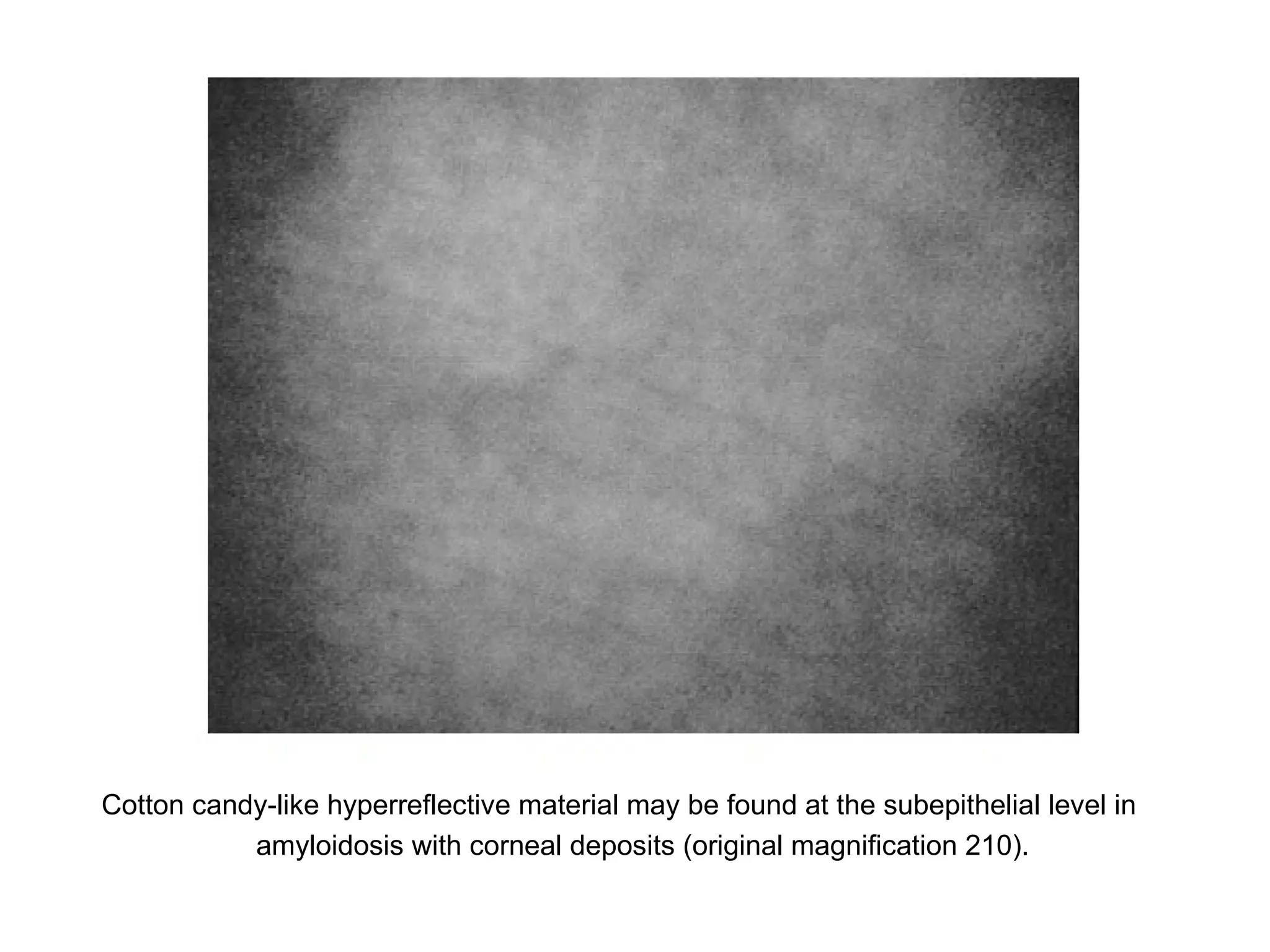 Cotton candy-like hyperreflective material may be found at the subepithelial level in
           amyloidosis with corneal deposits (original magnification 210).
 
