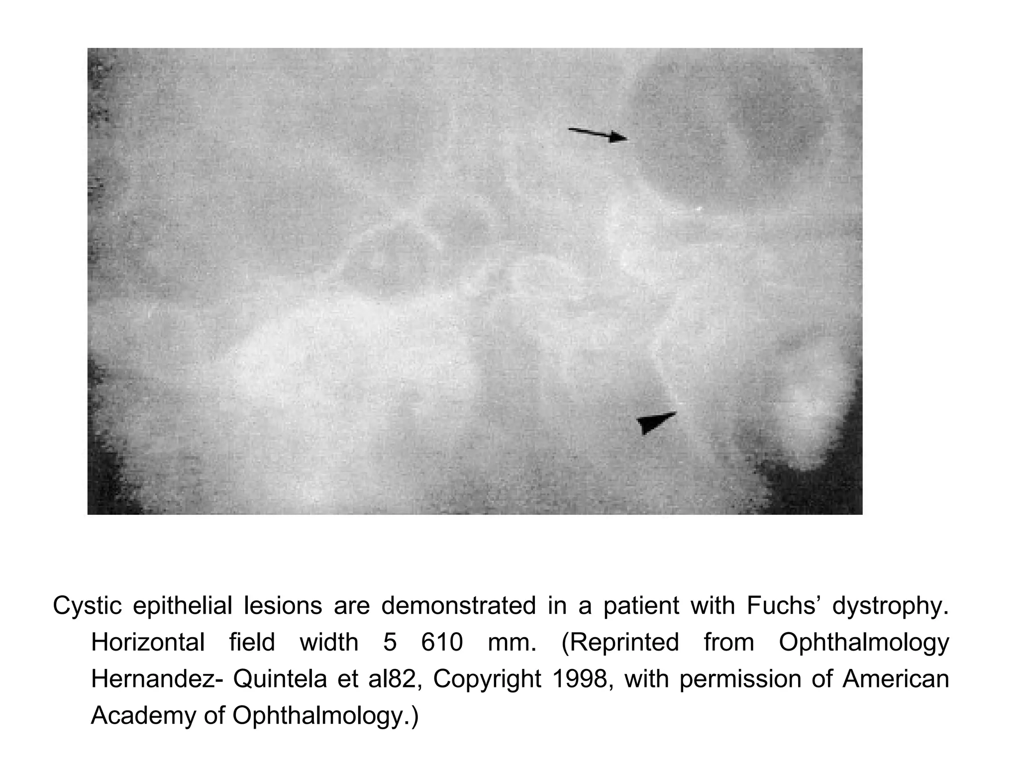 Cystic epithelial lesions are demonstrated in a patient with Fuchs’ dystrophy.
   Horizontal field width 5 610 mm. (Reprinted from Ophthalmology
   Hernandez- Quintela et al82, Copyright 1998, with permission of American
   Academy of Ophthalmology.)
 