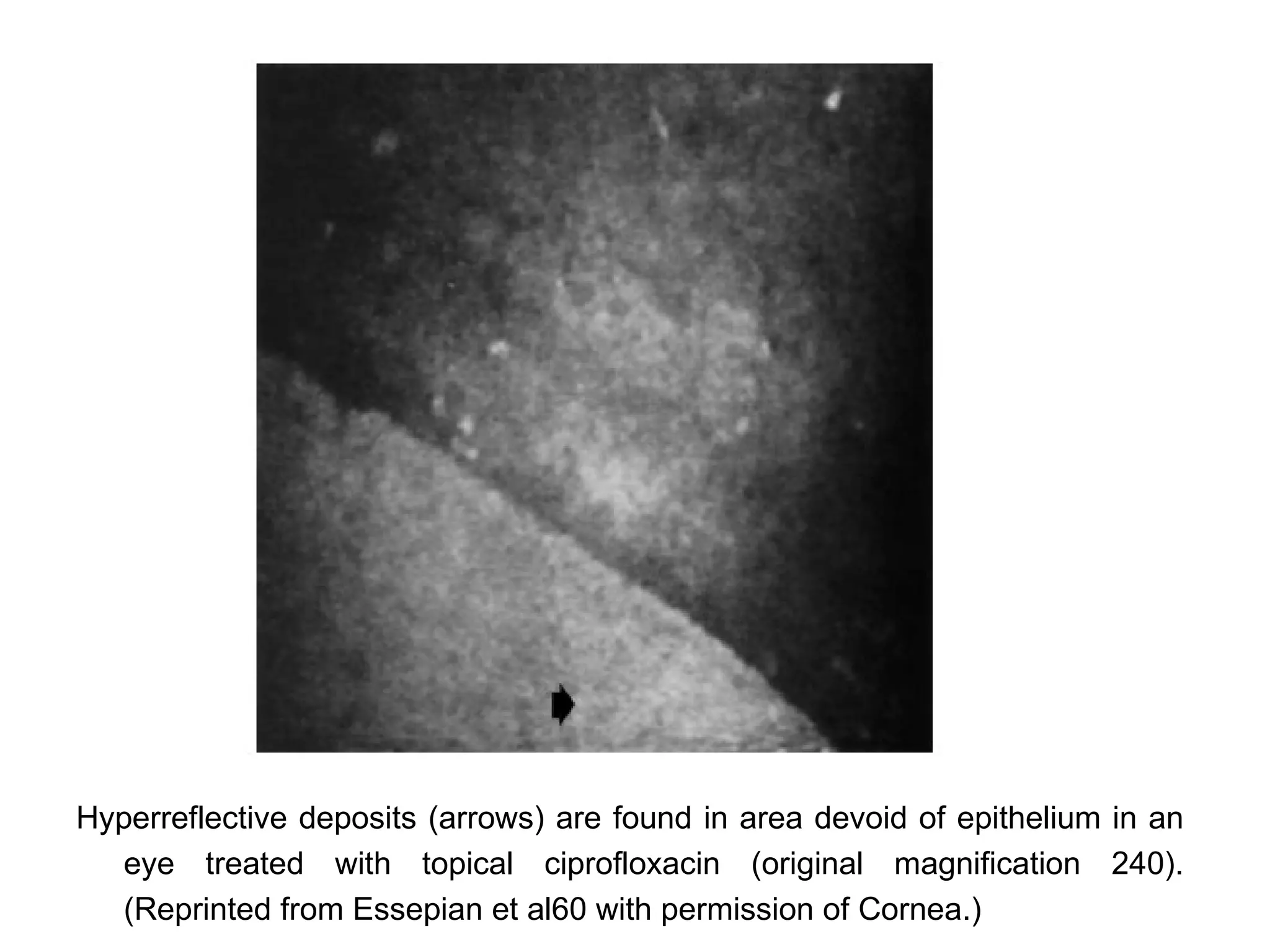 Hyperreflective deposits (arrows) are found in area devoid of epithelium in an
   eye treated with topical ciprofloxacin (original magnification 240).
   (Reprinted from Essepian et al60 with permission of Cornea.)
 