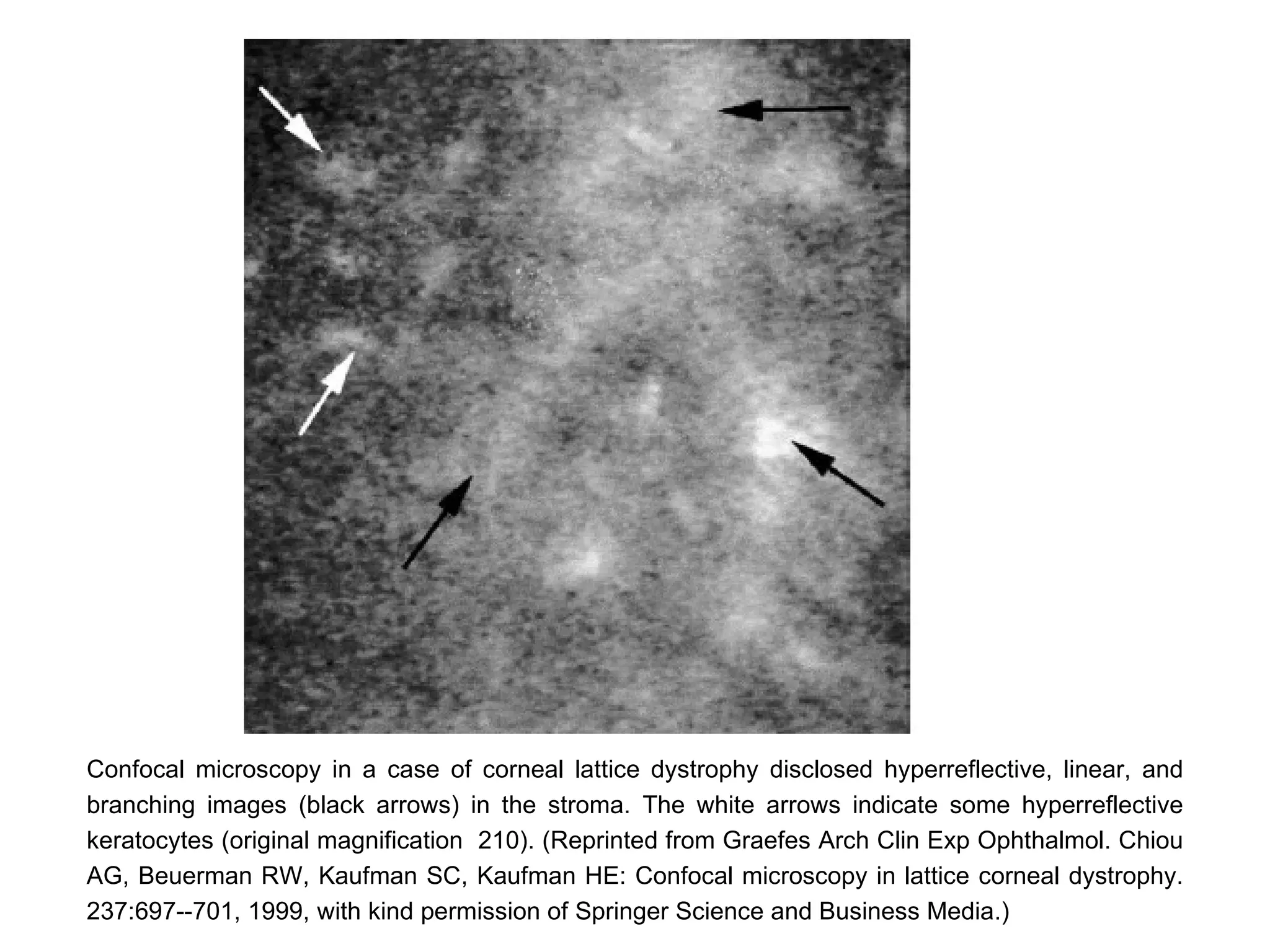 Confocal microscopy in a case of corneal lattice dystrophy disclosed hyperreflective, linear, and
branching images (black arrows) in the stroma. The white arrows indicate some hyperreflective
keratocytes (original magnification 210). (Reprinted from Graefes Arch Clin Exp Ophthalmol. Chiou
AG, Beuerman RW, Kaufman SC, Kaufman HE: Confocal microscopy in lattice corneal dystrophy.
237:697--701, 1999, with kind permission of Springer Science and Business Media.)
 