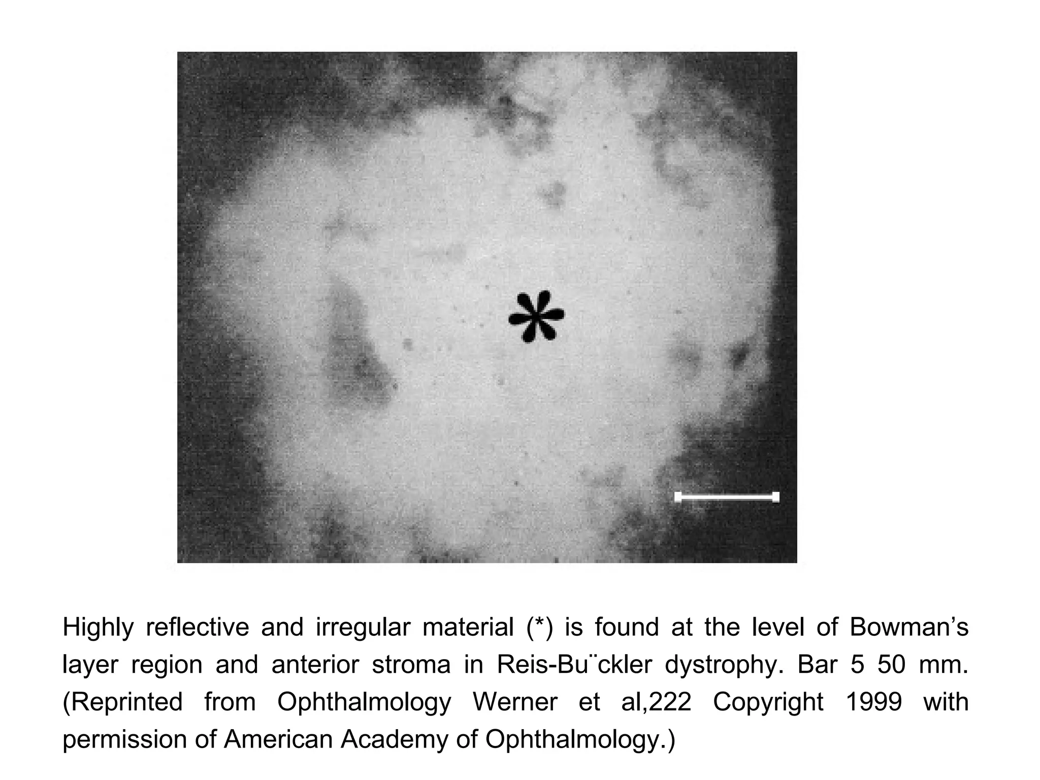 Highly reflective and irregular material (*) is found at the level of Bowman’s
layer region and anterior stroma in Reis-Bu¨ckler dystrophy. Bar 5 50 mm.
(Reprinted from Ophthalmology Werner et al,222 Copyright 1999 with
permission of American Academy of Ophthalmology.)
 