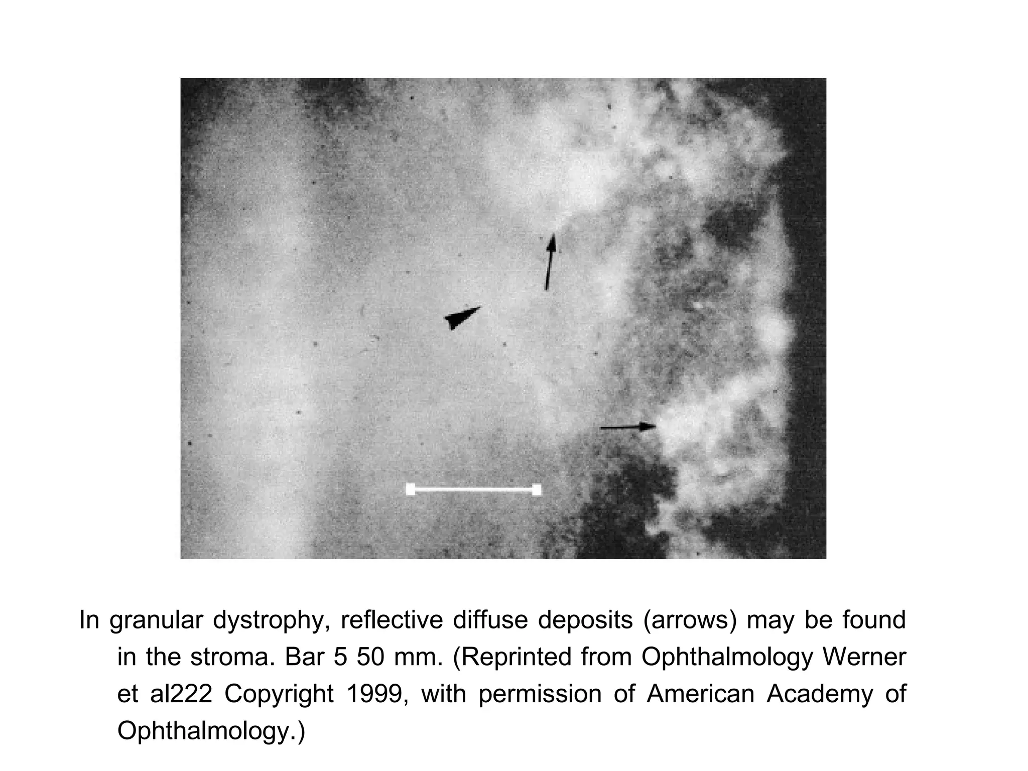 In granular dystrophy, reflective diffuse deposits (arrows) may be found
    in the stroma. Bar 5 50 mm. (Reprinted from Ophthalmology Werner
    et al222 Copyright 1999, with permission of American Academy of
    Ophthalmology.)
 