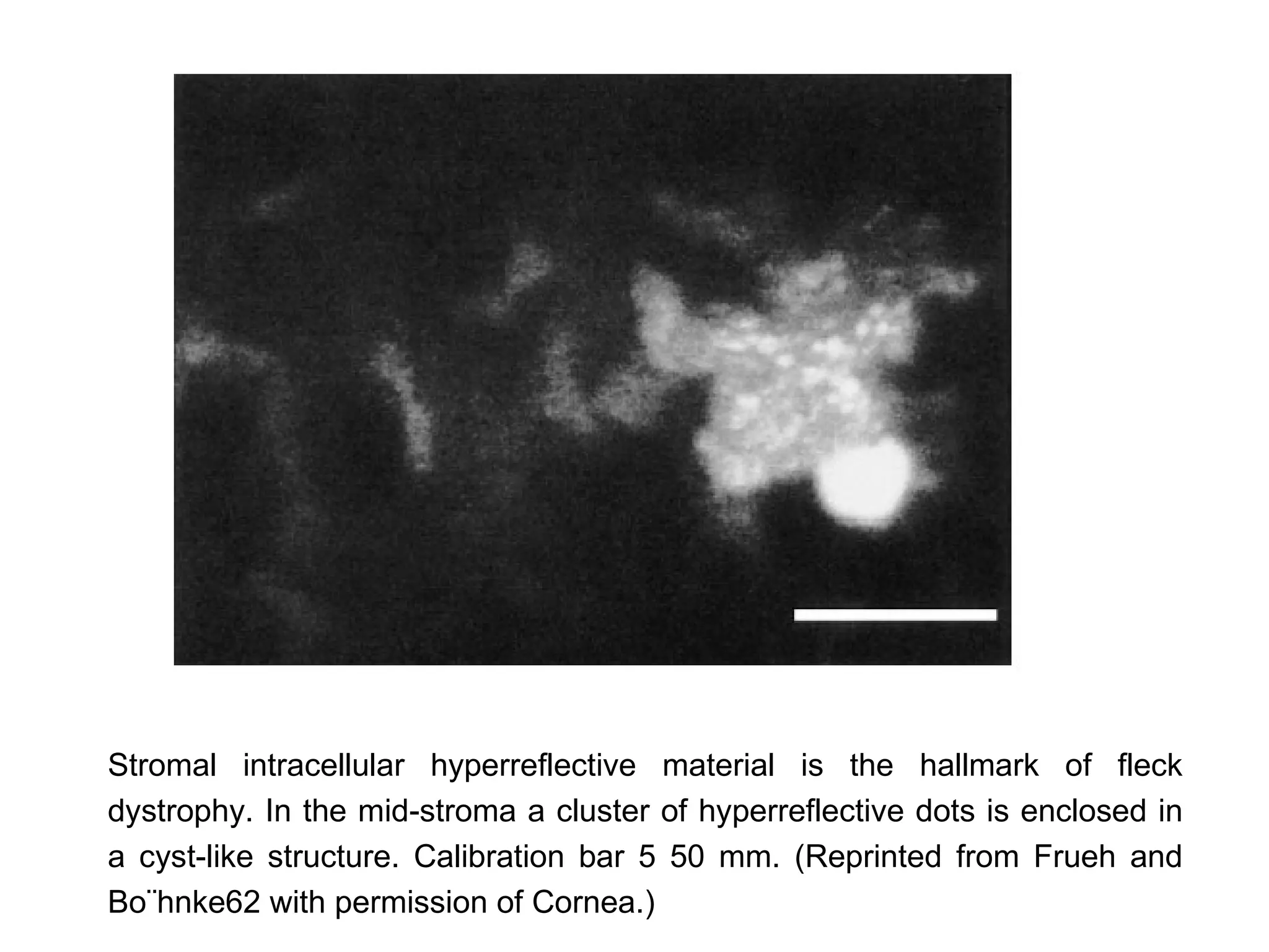 Stromal intracellular hyperreflective material is the hallmark of fleck
dystrophy. In the mid-stroma a cluster of hyperreflective dots is enclosed in
a cyst-like structure. Calibration bar 5 50 mm. (Reprinted from Frueh and
Bo¨hnke62 with permission of Cornea.)
 