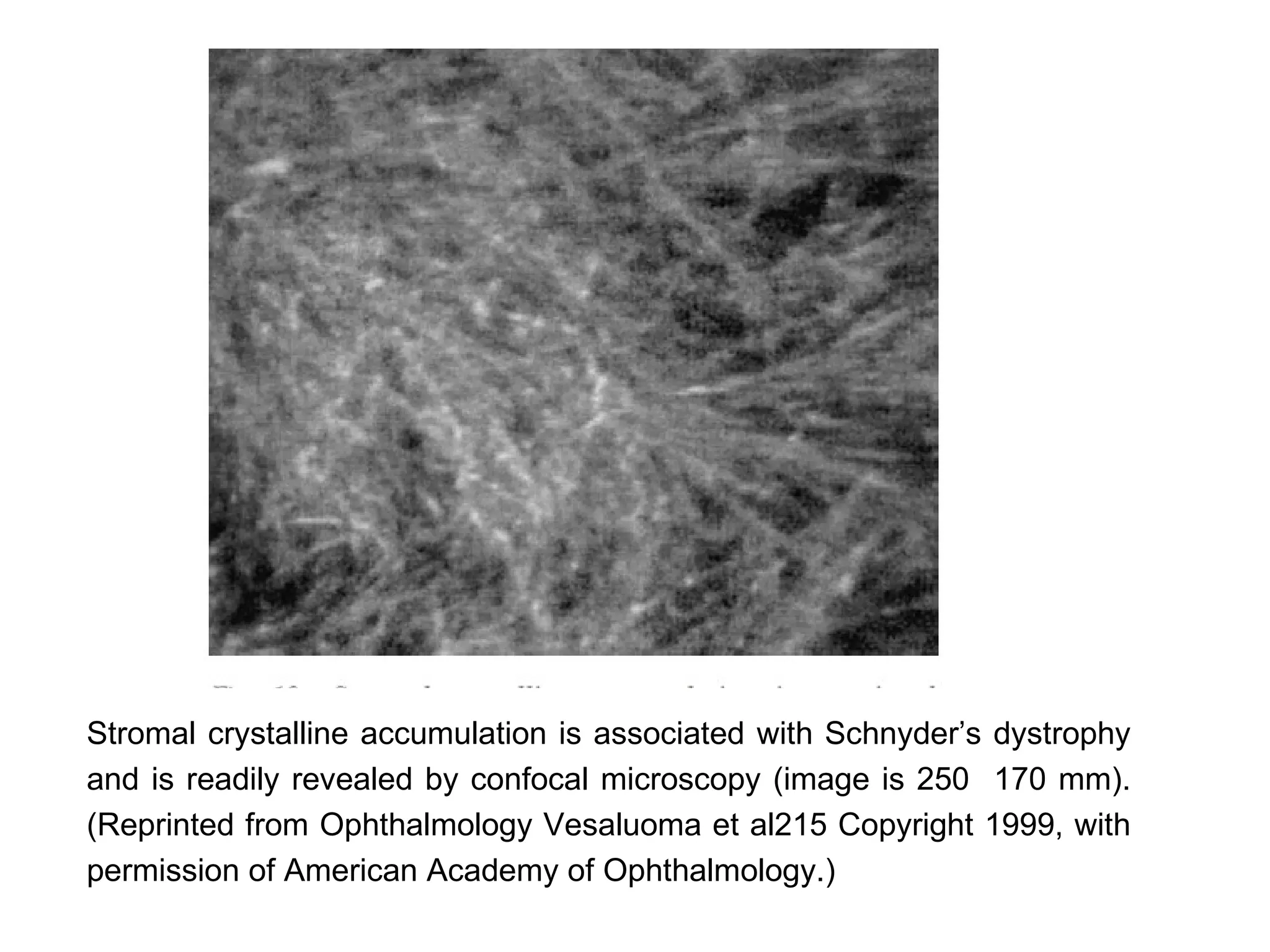 Stromal crystalline accumulation is associated with Schnyder’s dystrophy
and is readily revealed by confocal microscopy (image is 250 170 mm).
(Reprinted from Ophthalmology Vesaluoma et al215 Copyright 1999, with
permission of American Academy of Ophthalmology.)
 