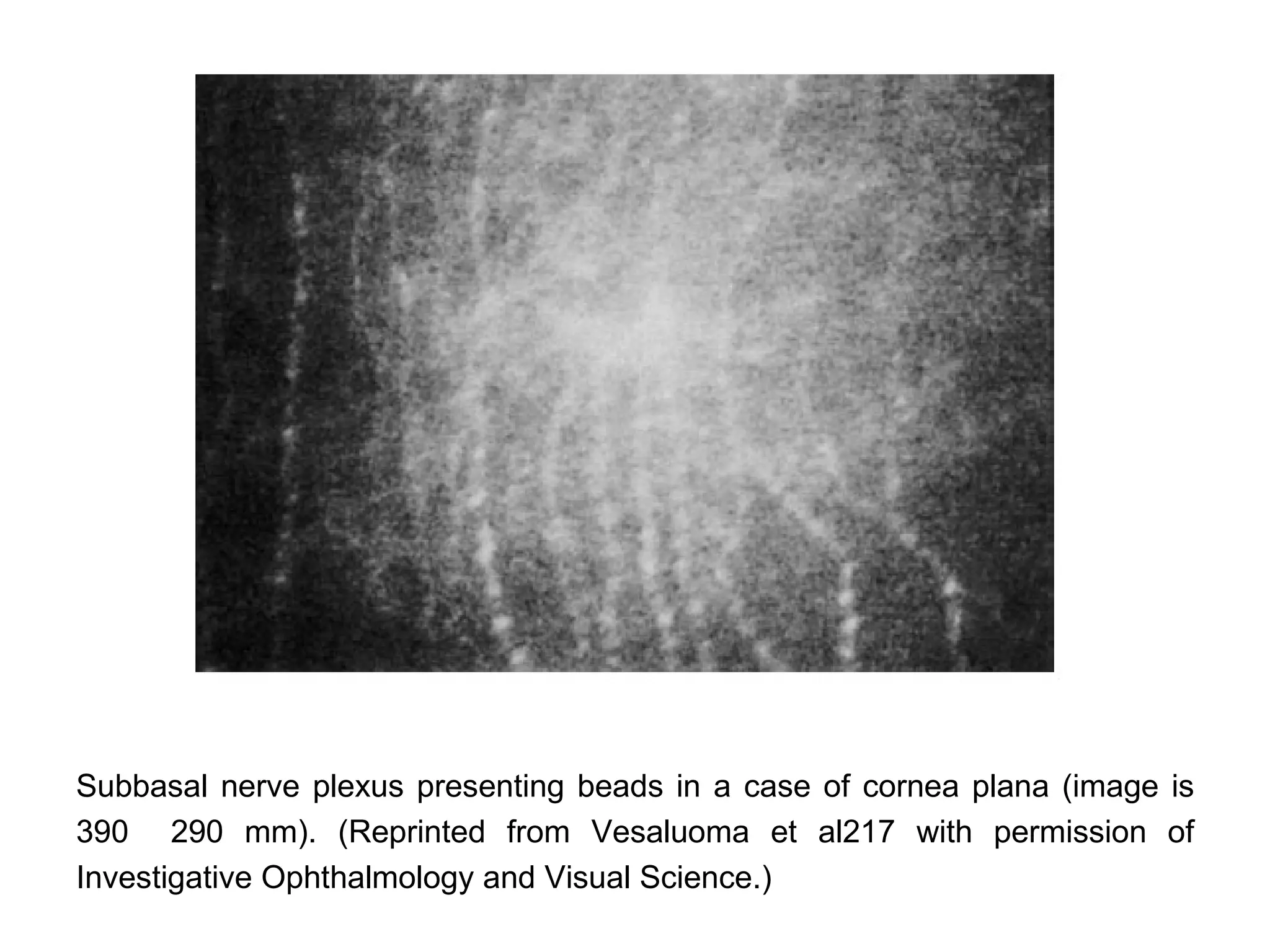 Subbasal nerve plexus presenting beads in a case of cornea plana (image is
390 290 mm). (Reprinted from Vesaluoma et al217 with permission of
Investigative Ophthalmology and Visual Science.)
 