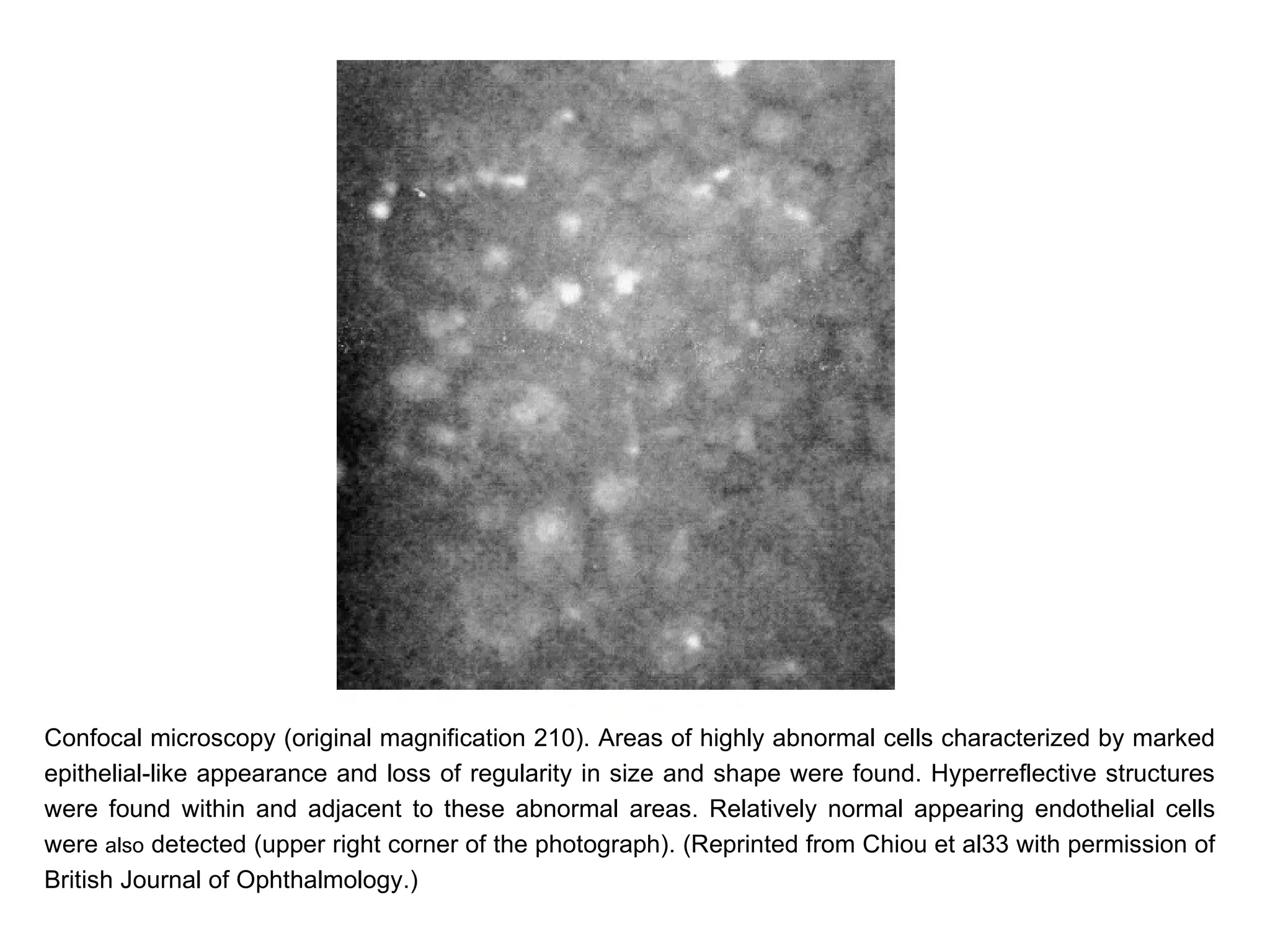 Confocal microscopy (original magnification 210). Areas of highly abnormal cells characterized by marked
epithelial-like appearance and loss of regularity in size and shape were found. Hyperreflective structures
were found within and adjacent to these abnormal areas. Relatively normal appearing endothelial cells
were also detected (upper right corner of the photograph). (Reprinted from Chiou et al33 with permission of
British Journal of Ophthalmology.)
 