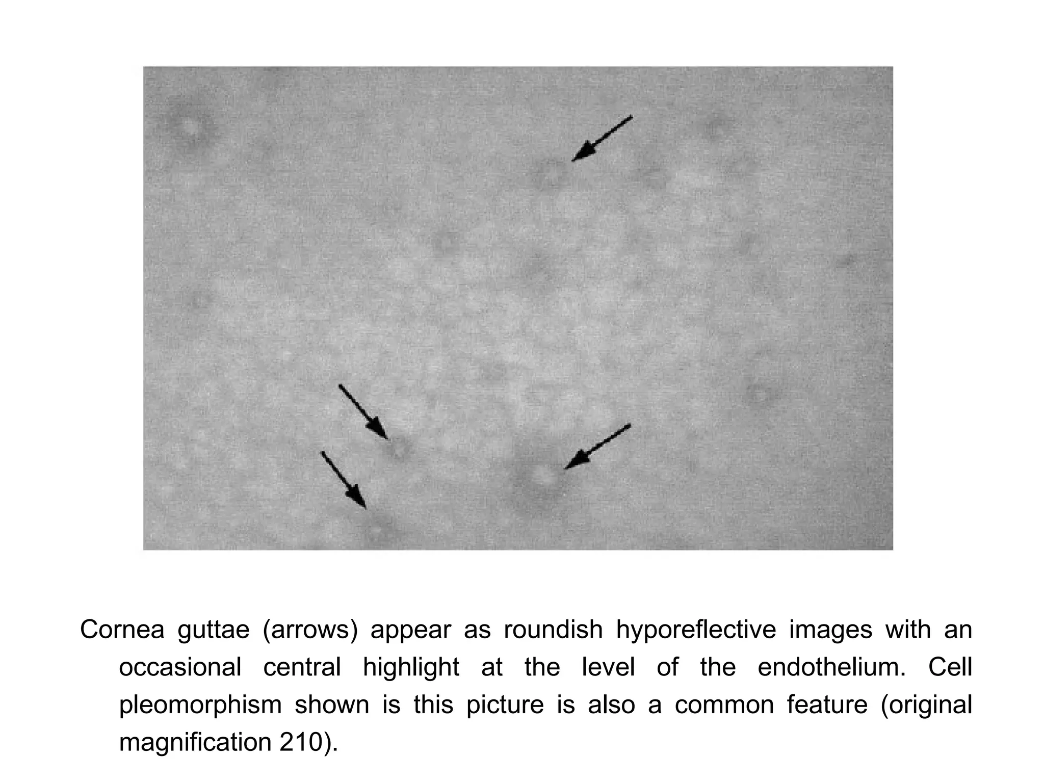 Cornea guttae (arrows) appear as roundish hyporeflective images with an
   occasional central highlight at the level of the endothelium. Cell
   pleomorphism shown is this picture is also a common feature (original
   magnification 210).
 