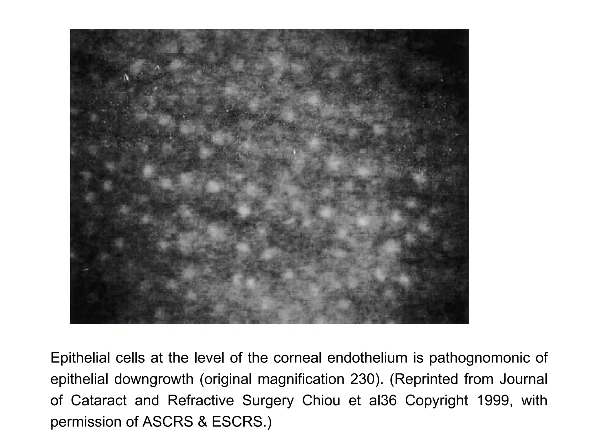 Epithelial cells at the level of the corneal endothelium is pathognomonic of
epithelial downgrowth (original magnification 230). (Reprinted from Journal
of Cataract and Refractive Surgery Chiou et al36 Copyright 1999, with
permission of ASCRS & ESCRS.)
 