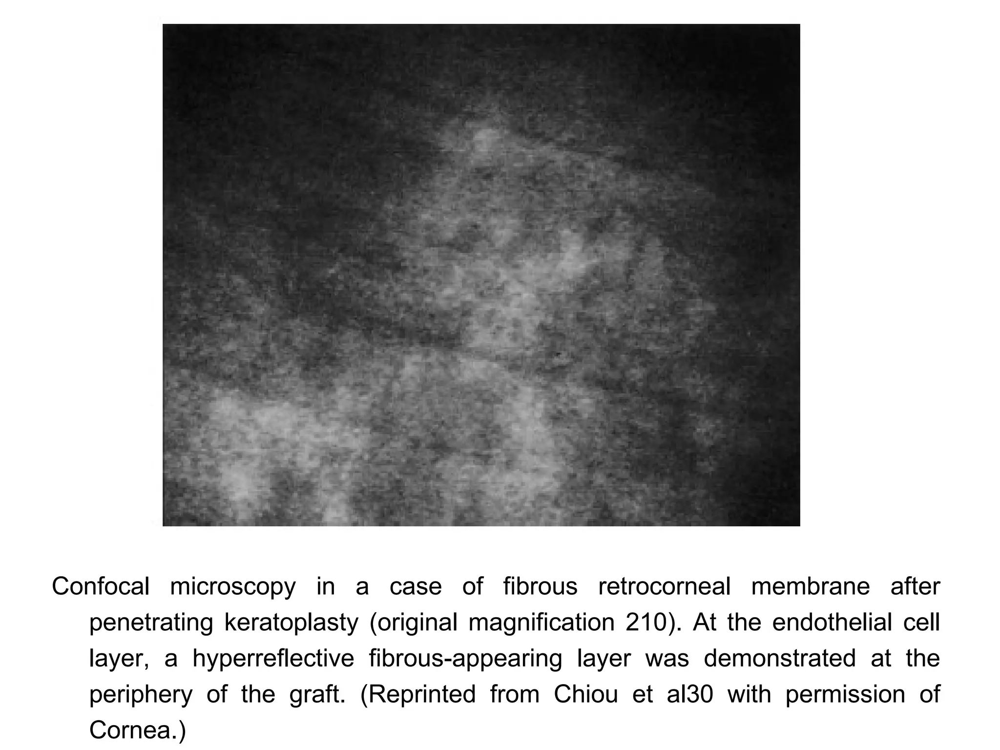 Confocal microscopy in a case of fibrous retrocorneal membrane after
  penetrating keratoplasty (original magnification 210). At the endothelial cell
  layer, a hyperreflective fibrous-appearing layer was demonstrated at the
  periphery of the graft. (Reprinted from Chiou et al30 with permission of
  Cornea.)
 