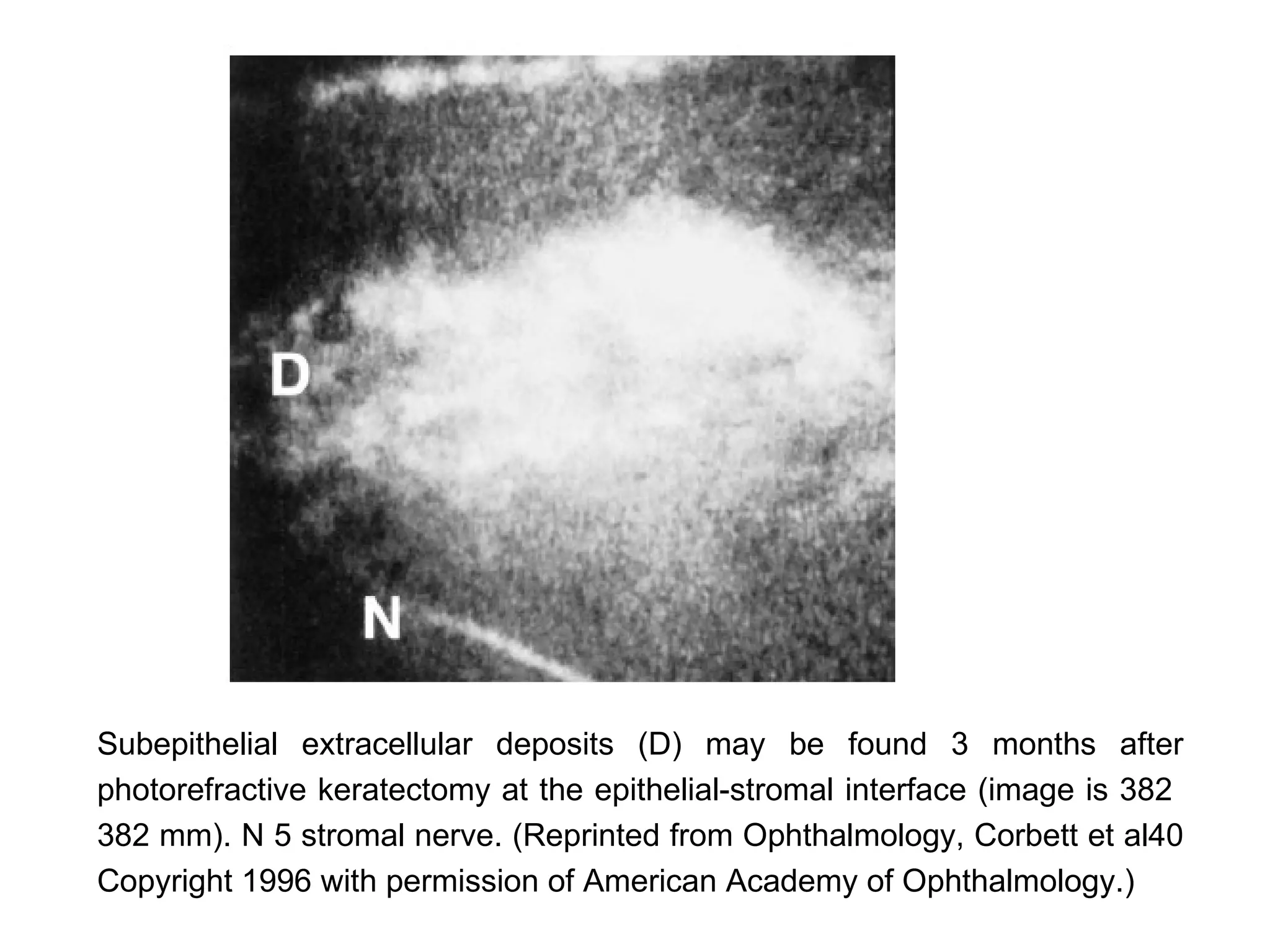 Subepithelial extracellular deposits (D) may be found 3 months after
photorefractive keratectomy at the epithelial-stromal interface (image is 382
382 mm). N 5 stromal nerve. (Reprinted from Ophthalmology, Corbett et al40
Copyright 1996 with permission of American Academy of Ophthalmology.)
 