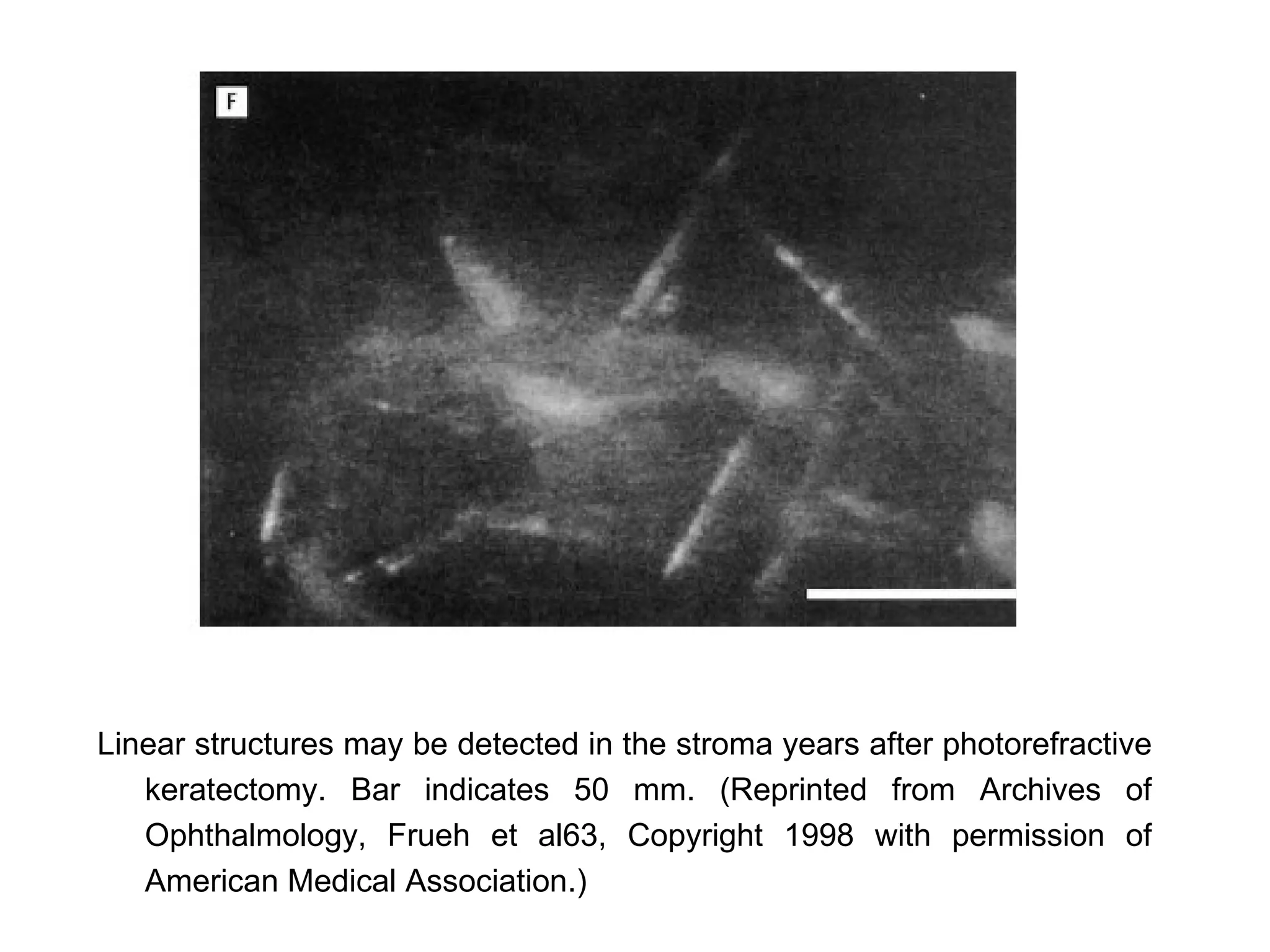 Linear structures may be detected in the stroma years after photorefractive
   keratectomy. Bar indicates 50 mm. (Reprinted from Archives of
   Ophthalmology, Frueh et al63, Copyright 1998 with permission of
   American Medical Association.)
 