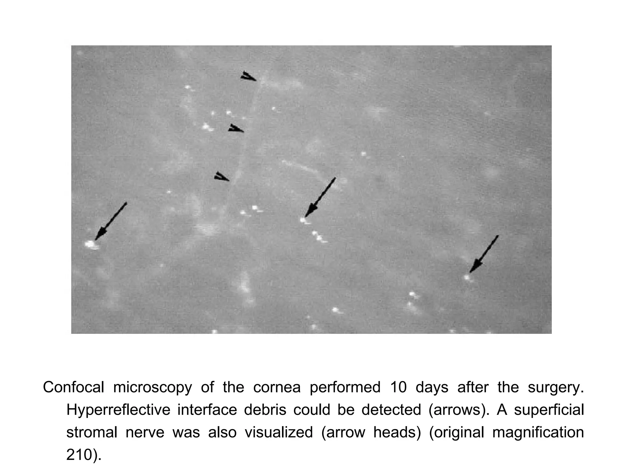 Confocal microscopy of the cornea performed 10 days after the surgery.
  Hyperreflective interface debris could be detected (arrows). A superficial
  stromal nerve was also visualized (arrow heads) (original magnification
  210).
 