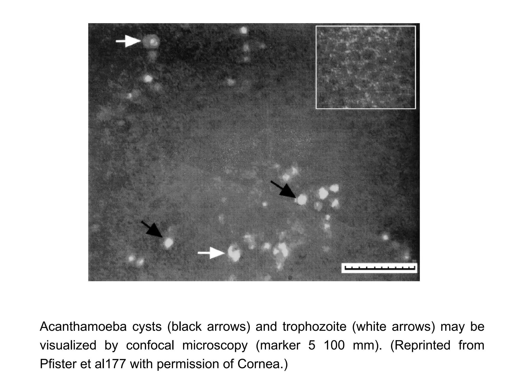 Acanthamoeba cysts (black arrows) and trophozoite (white arrows) may be
visualized by confocal microscopy (marker 5 100 mm). (Reprinted from
Pfister et al177 with permission of Cornea.)
 
