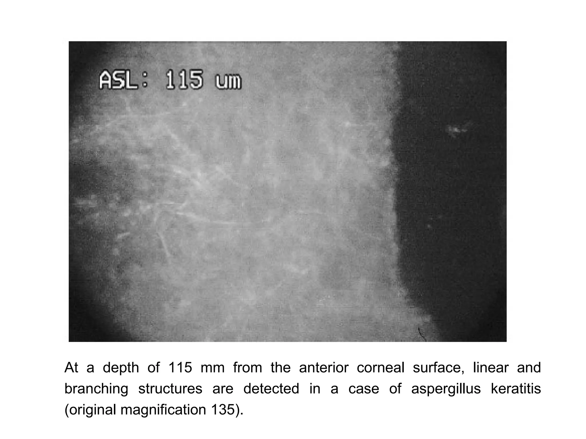 At a depth of 115 mm from the anterior corneal surface, linear and
branching structures are detected in a case of aspergillus keratitis
(original magnification 135).
 