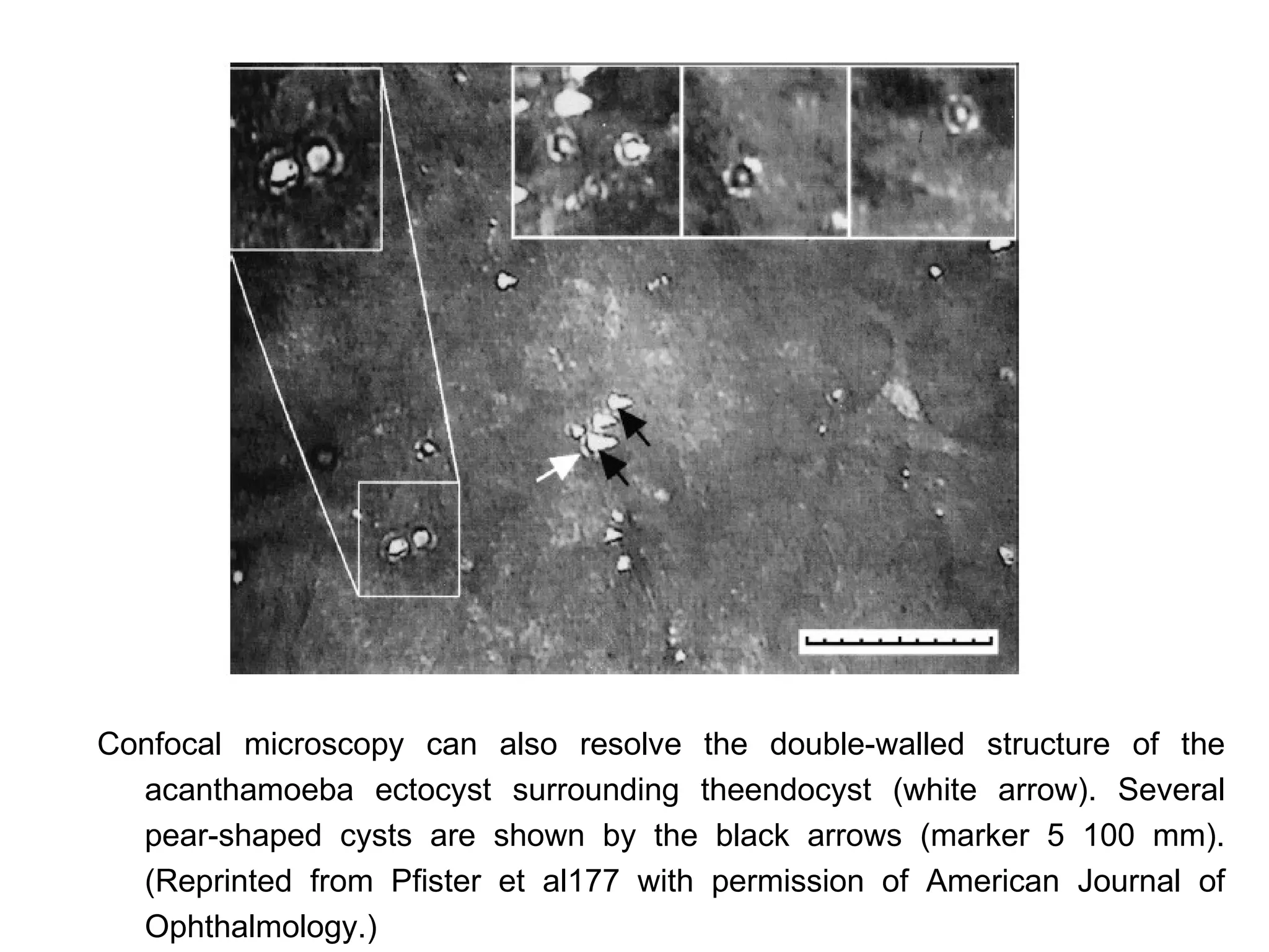 Confocal microscopy can also resolve the double-walled structure of the
  acanthamoeba ectocyst surrounding theendocyst (white arrow). Several
  pear-shaped cysts are shown by the black arrows (marker 5 100 mm).
  (Reprinted from Pfister et al177 with permission of American Journal of
  Ophthalmology.)
 