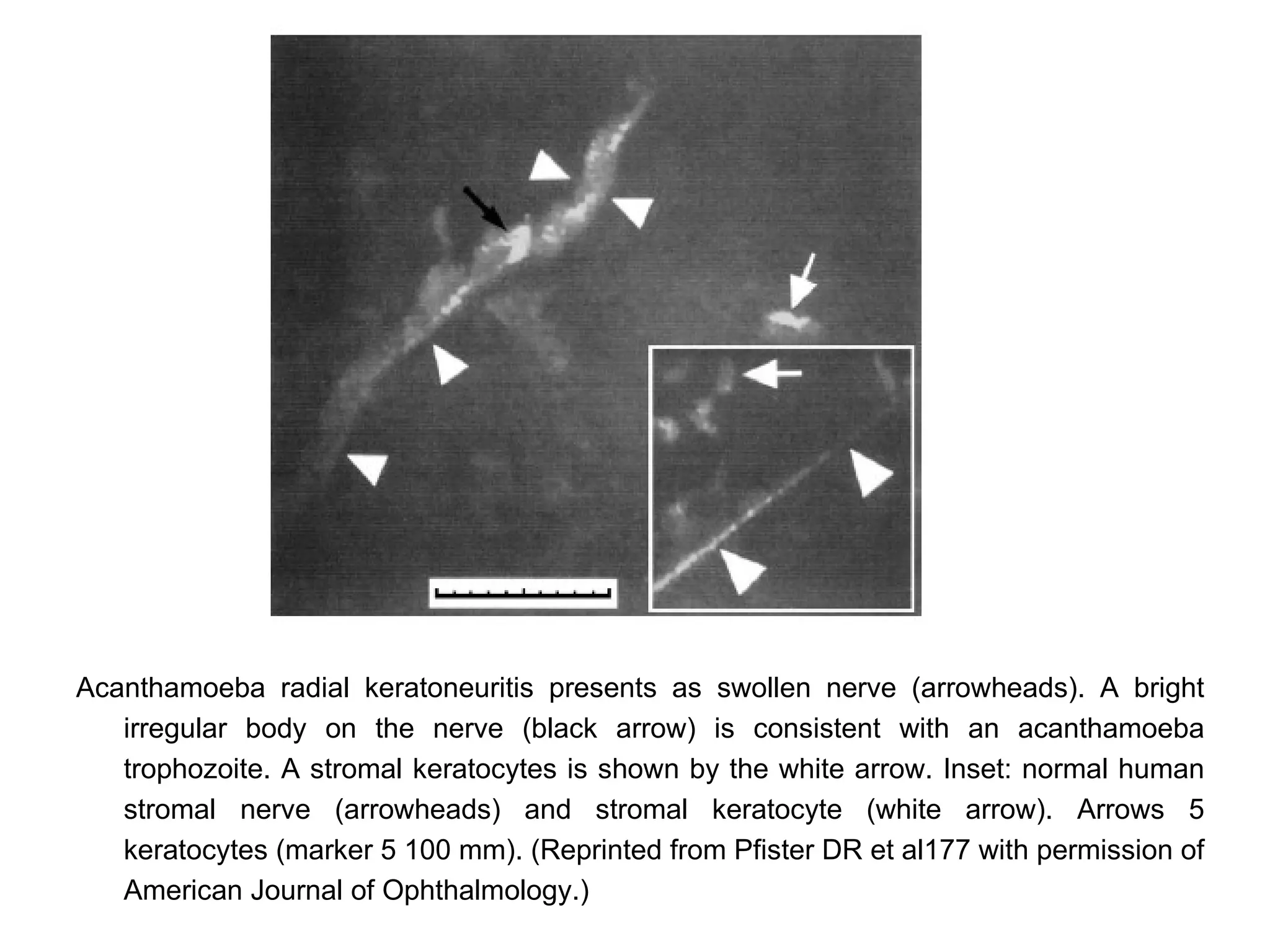 Acanthamoeba radial keratoneuritis presents as swollen nerve (arrowheads). A bright
   irregular body on the nerve (black arrow) is consistent with an acanthamoeba
   trophozoite. A stromal keratocytes is shown by the white arrow. Inset: normal human
   stromal nerve (arrowheads) and stromal keratocyte (white arrow). Arrows 5
   keratocytes (marker 5 100 mm). (Reprinted from Pfister DR et al177 with permission of
   American Journal of Ophthalmology.)
 